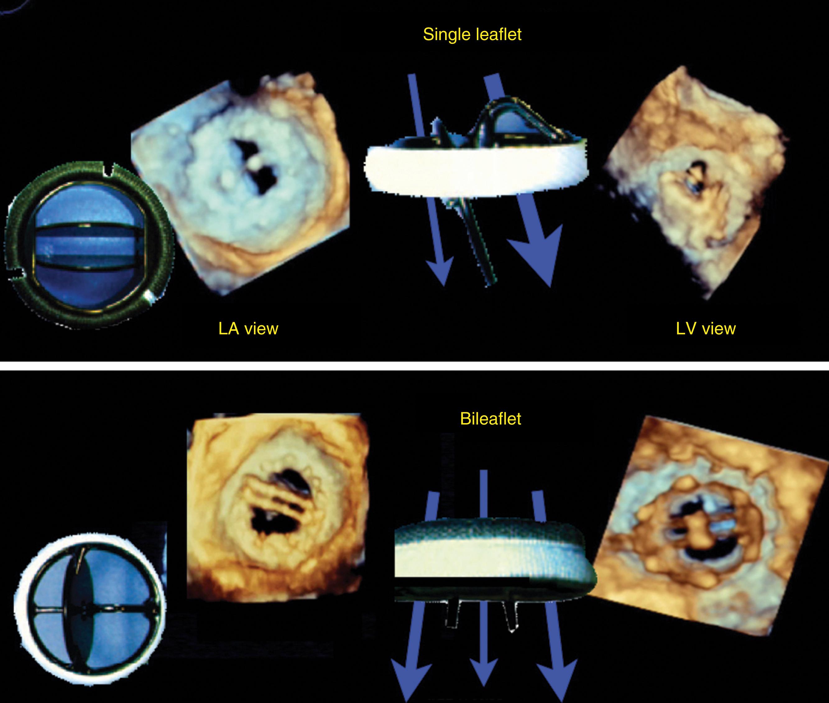 Figure 11.13, Flows across mechanical prosthetic valves. This figure highlights the differences in both appearance and flow across a single-leaflet and a bileaflet mechanical prosthetic valve. Three-dimensional echocardiographic imaging shows valves, in mitral position, from the perspectives of the left atrium (LA) and left ventricle (LV) and highlights the paths through which blood flows while traversing the valve.