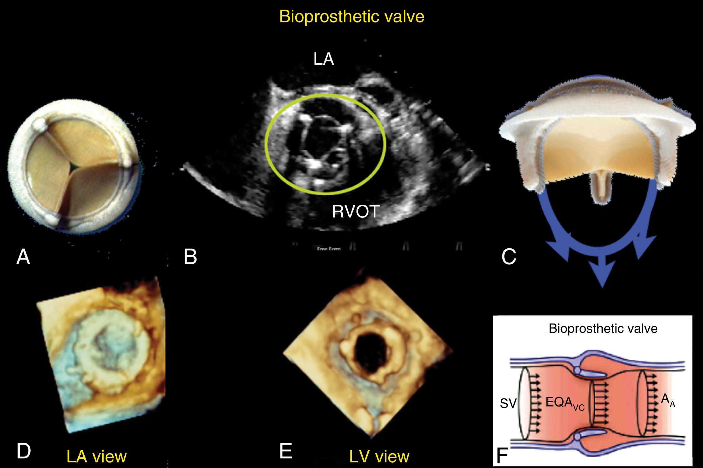 Figure 11.14, Flows across bioprosthetic valves. The figure highlights the appearance and flow across a bioprosthetic valve. The valve is shown in the mitral and aortic positions. (A) and (B) Valve in short-axis view looking from downstream. (C) View highlighting the main single forward flow pattern. (D) and (E) Three-dimensional echocardiographic views of the mitral position from the left atrial (LA) perspective during systole and the left ventricular (LV) perspective during diastole. (F) Another view highlighting the main single forward flow pattern. A A , Ascending aorta; EQA VC , estimated qualitative area vena contracta; RVOT , right ventricular outflow tract; SV , stroke volume.