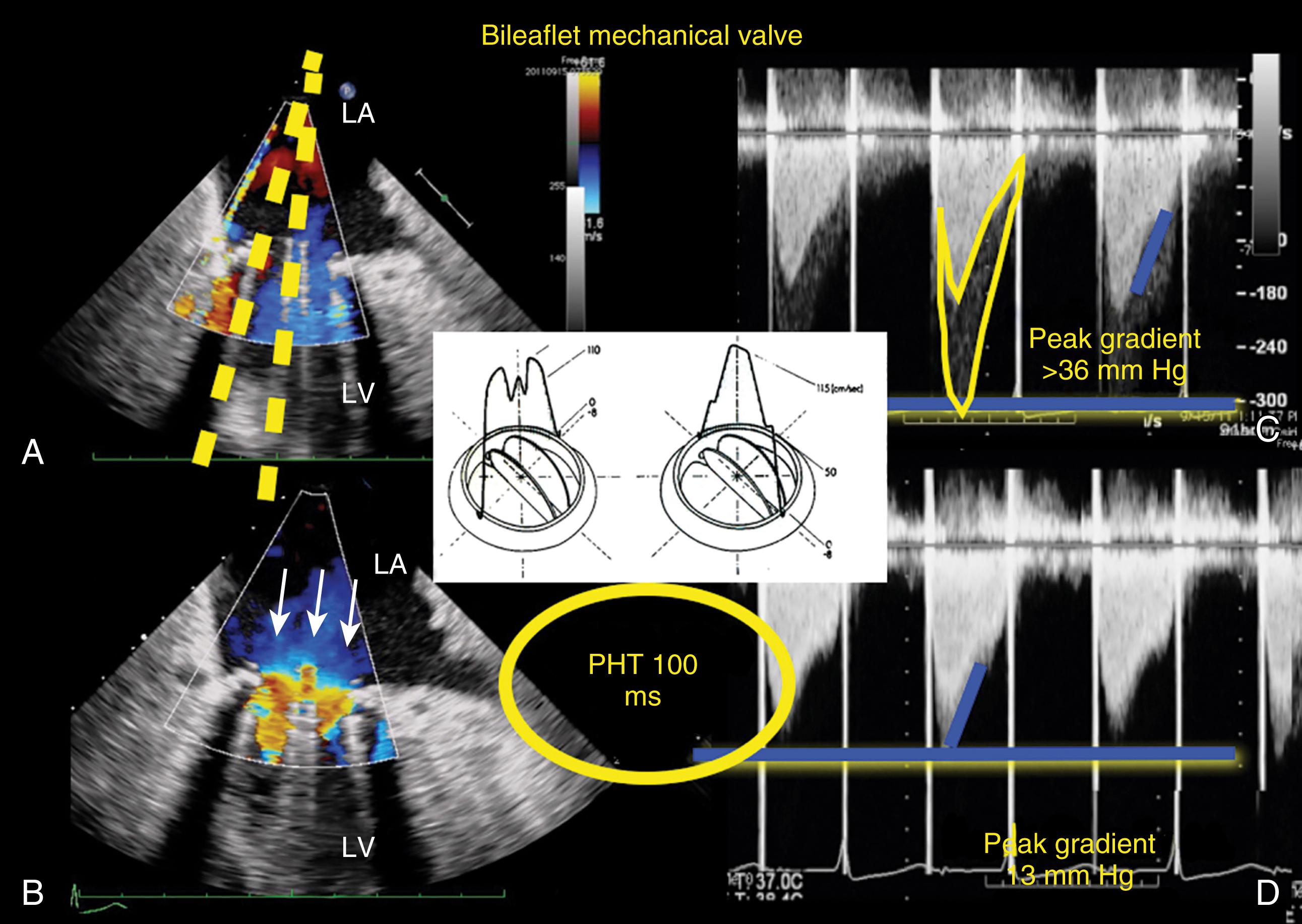 Figure 11.15, Normal flows across a bileaflet mechanical valve. (A) and (B) Imaging of a bileaflet mechanical valve perpendicular to the leaflets. Three forward jets of blood flow through the two lateral orifices and one central orifice. Flow through these orifices is on a slight stagger, as seen in the schematic in the middle. (C) The flow through the middle orifice passes with a higher velocity and may record a higher gradient than what is truly representative of the valve. The Doppler profile shows two components: a lower and more dense profile, which suggests the large majority of flow, which represents flow through the lateral orifices, and a faster less dense profile (fewer blood cells) that comes from the central orifice. The Doppler profile records a high peak gradient (>36 mm Hg) from the central orifice that does not accurately reflect the mitral valve area measured by the pressure half-time (PHT) technique (220/100 ms = 2.2 cm 2 ). (D) The more dense profile from a lateral orifice is more consistent with a larger valve area recorded using the PHT. LA , Left atrium; LV , left ventricle.