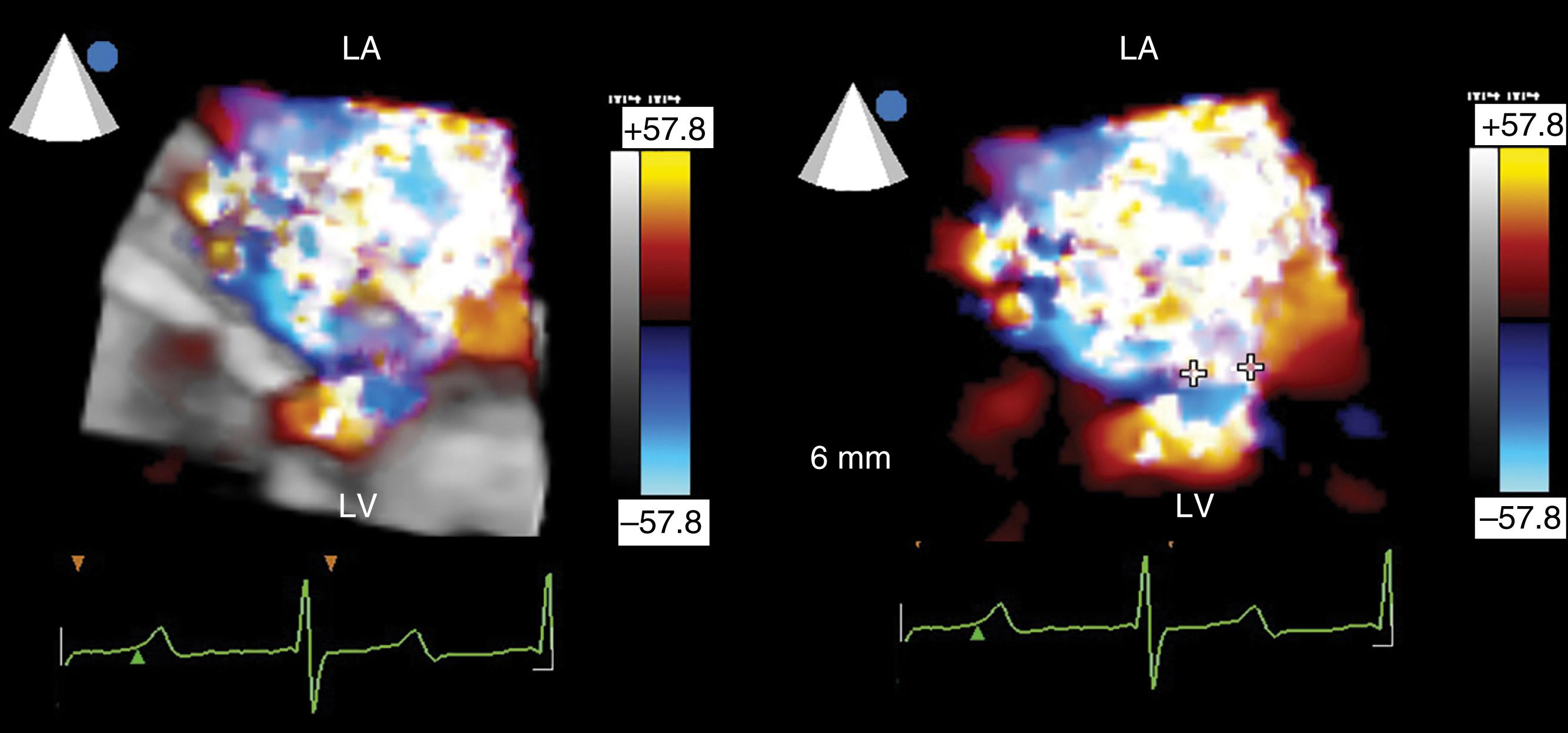 Figure 11.18, Three-dimensional (3D) color Doppler imaging of a regurgitant mitral jet. The two images demonstrate the use of 3D color Doppler imaging to image flow from multiple levels to see the full shape of, in this case, regurgitant flow. Shown is the evaluation of a paravalvular regurgitant jet of a prosthetic mitral valve. The regurgitant jet is seen below, at, and above the valve to allow a more accurate measure of the vena contracta. As seen in Fig. 11.51 , expansion of the regurgitant jet is seen on the atrial side. This expansion helps to understand why the regurgitant jet area may not reflect the regurgitant orifice accurately. In the case, the 3D view of the regurgitant flow aided in determining the size and number of occluder devices. LA , Left atrium; LV , left ventricle.