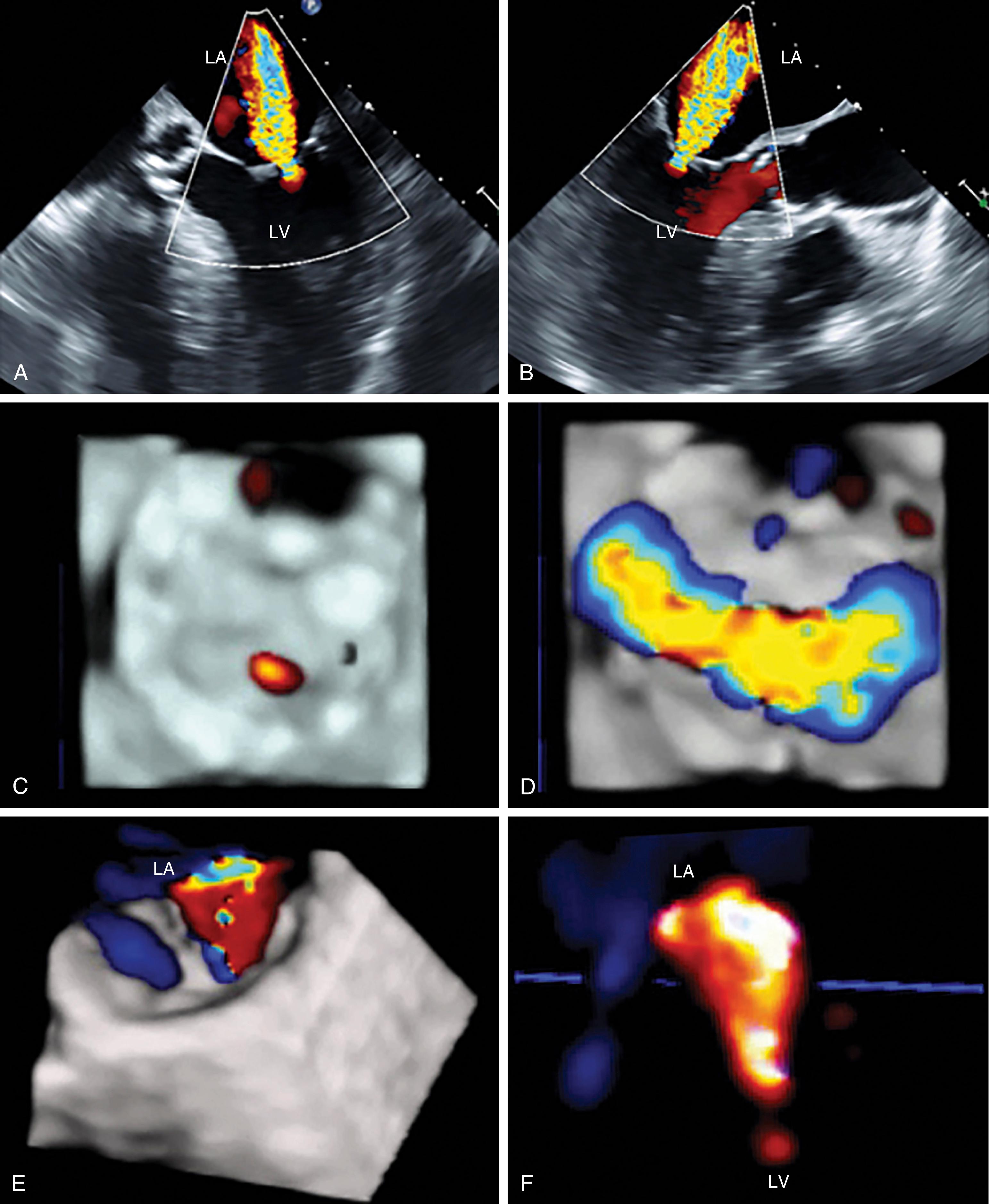 Figure 11.19, Entrainment of the regurgitant jet. (A) and (B) Centrally regurgitant jet from the midesophageal windows. (C) The regurgitant orifice from the left ventricular perspective during systole. (D) Flow during diastole. (E) and (F) Three-dimensional shape of the regurgitant jet on multiple levels as it passes through the regurgitant valve orifice. The jet appears to expand as a result of entrainment. This explains why the vena contracta is a better reflection of the regurgitant orifice than the subsequent jet area, the latter overestimating the regurgitant orifice area due to entrainment. LA , Left atrium; LV , left ventricle.