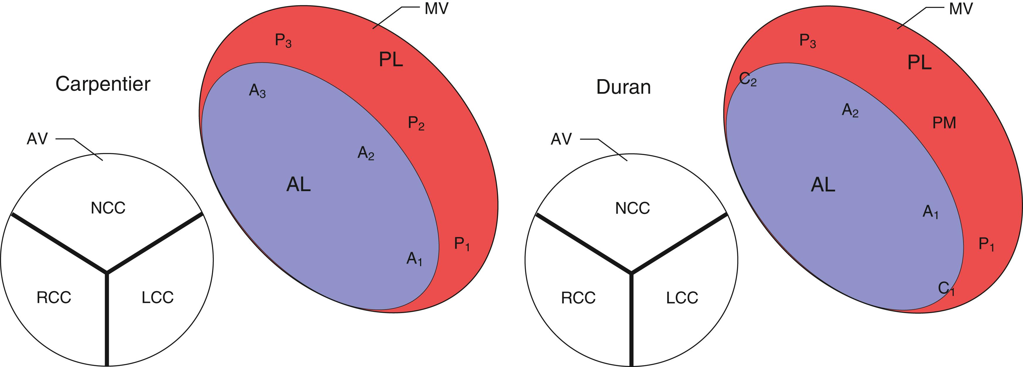 Figure 11.20, Schematic showing the Carpentier and Duran nomenclatures of the mitral leaflet scallops. Whereas both recognize the posterior leaflet as having three scallops (P 1 , P 2 , P 3 ), the Duran labeling distinguishes the anterior leaflet as an anterior lateral section (A 1 ) and a posteromedial section (A 2 ) and two commissural areas on the periphery (C 1 and C 2 ). In contrast, the Carpentier nomenclature identifies three scallops on the anterior leaflet (A 1 , A 2 , A 3 ) corresponding to those on the posterior leaflet. AL , Anterior leaflet; AV , aortic valve; LA , left atrium; LAA , left atrial appendage; LCC , left coronary cusp (of the aortic valve); LV , left ventricle; MV , mitral valve; NCC , noncoronary cusp; RCC , right coronary cusp; PL , posterior leaflet.