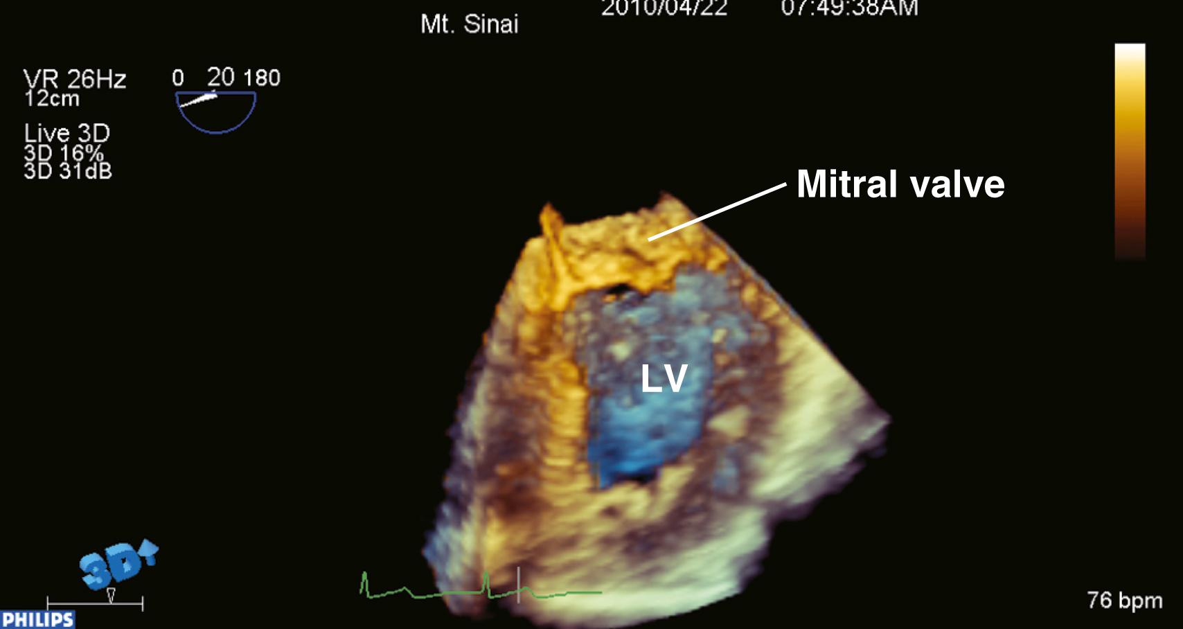 Figure 11.2, Live three-dimensional image of mitral valve and left ventricle (LV). Because of the matrix structure of the ultrasound transducer, this image represents a true live image. Change in transesophageal echocardiographic probe positioning by the echocardiographer results in instantaneous changes in the volumetric data set.