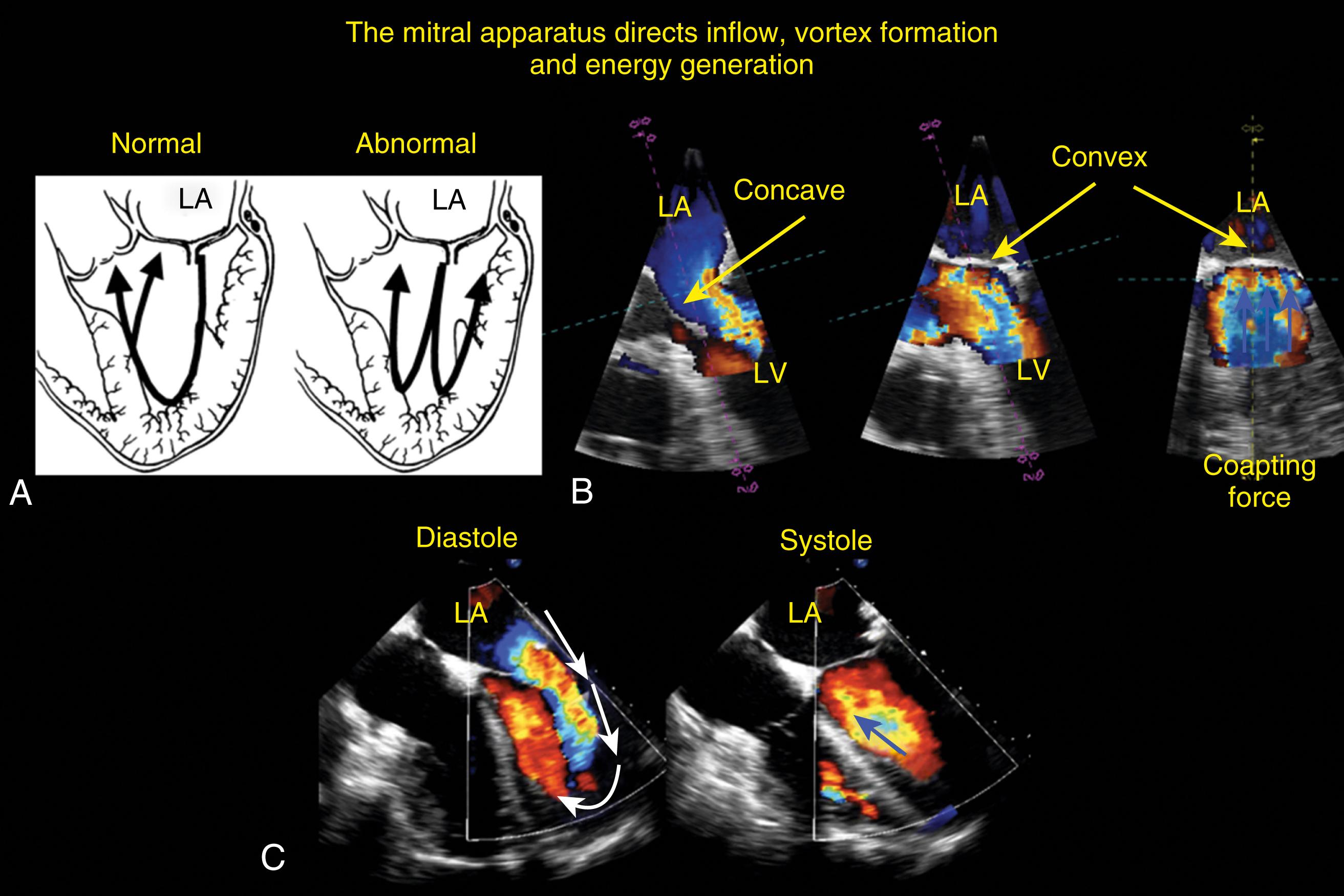 Figure 11.21, Flow directions of transmitral and intracavitary flows. (A) Schematic showing normal and abnormal patterns. The normal pattern consists of transmitral flow directed toward the left ventricular apex along the posterolateral wall, which is followed by flow directed toward the left ventricular outflow tract along the anterior and anteroseptal walls. This normal pattern is associated with the development of normal flow vortexes, which creates energy, all contributing toward more efficient flow, which minimizes the chance of systolic outflow interacting with slack mitral leaflet portions, thereby increasing the risk of systolic anterior motion (SAM). By contrast, the abnormal flow patterns create less energy and are less efficient. Furthermore, its flow directions have potential implications when the different flows potentially interact with slack mitral leaflets and increase the chance of SAM. (B) and (C) Movement of the anterior leaflet and how it directs blood flow into the left ventricle. Normal changes in the mitral leaflets create normal flow patterns resulting in normal flow configurations. LA , Left atrium; LV , left ventricle.