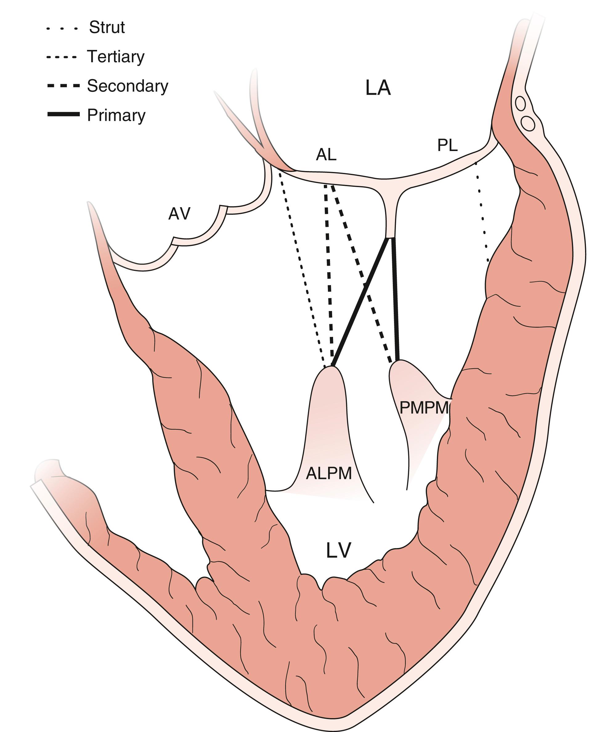 Figure 11.22, Chordal anatomy. Schematic shows the four main categories of chordae tendineae that allow the mitral valve to function normally, which includes its effect on left ventricular shape and function. The primary chords are responsible for normal coaptation. The secondary chords associated with the tethering phenomenon seen during left ventricular remodeling have been a target of repair (cutting) for type IIIb mitral regurgitation. The tertiary chords attach from the papillary muscle to the base of the anterior leaflet, while the strut chords connect that base of the posterior leaflet to the posterolateral left ventricular wall. AL , Anterior leaflet; ALPM , anterolateral papillary muscle; AV , aortic valve; LA , left atrium; LAA , left atrial appendage; LV , left ventricle; PL , posterior leaflet; PMPM , posteromedial papillary muscle.