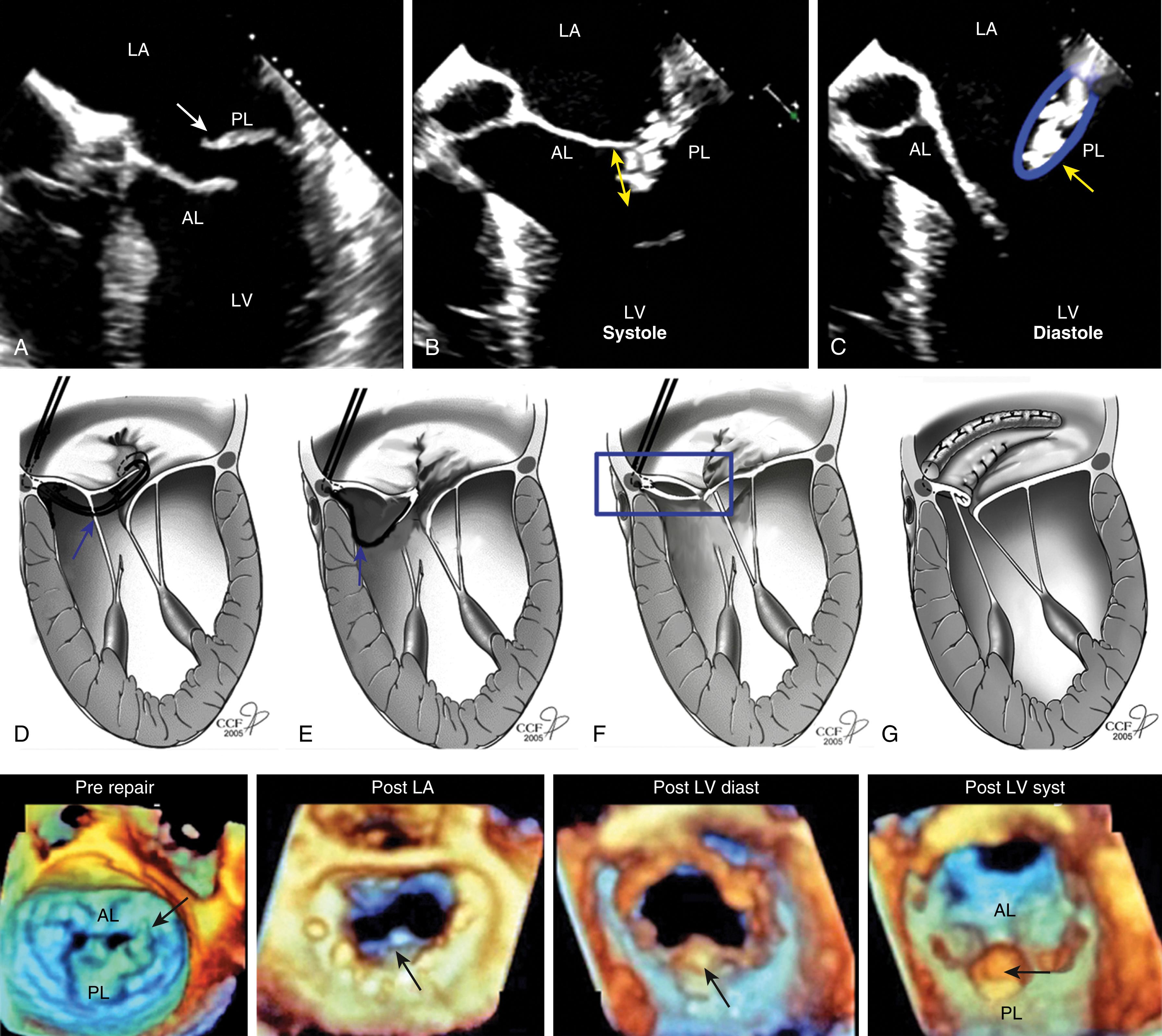 Figure 11.24, Before and after valve repair. The folding leaflet plasty is a repair technique that reduces posterior leaflet (PL) height without resecting the leaflet. Suture is placed on the edge of the prolapsing scallop, passed below (left ventricle [LV] side) the leaflet and then through the respective annular segment. The leaflet is pulled down and folded over itself to produce a significant coapting surface for the anterior leaflet. (A) Patient with a flail PL. (B) and (C) Same patient postrepair image obtained during LV systole (syst) and diastole (diast) , respectively. (B) shows the coaptation zone (yellow arrow) created by the folding plasty, which can be seen in (C) ( blue surround that is pointed to by the yellow arrow ). (D) and (E) Path of repair suture (blue arrow) , until (F) leaflet is folded (blue box). (G) Annuloplasty ring supporting the repair. The lower series of images are three-dimensional views of the repair. The black arrow in the first image on the left shows the flail PL and torn chord (thin black arrow) , while the next three show the repair with the folded PL highlighted by the black arrows . AL , Anterior leaflet; LA , left atrium.