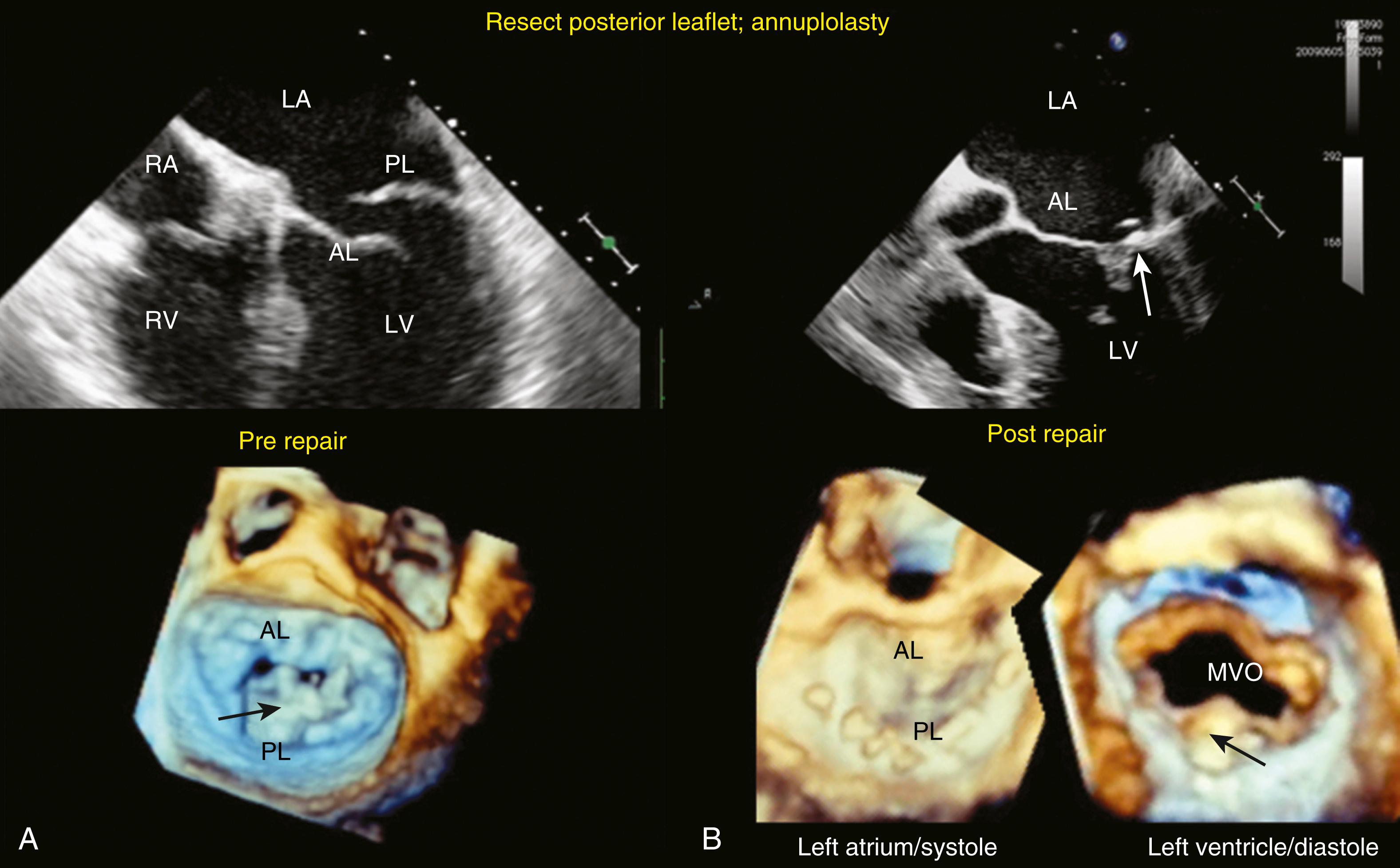 Figure 11.25, Before and after mitral valve repair. (A) In the pre-repair period, the posterior leaflet (PL) is seen as flail. The three-dimensional image similarly shows the flail scallop (arrow) , which in this case is the middle scallop of the posterior leaflet (P 2 ) with two torn chordae. (B) The repaired valve is mostly dependent on the anterior leaflet (AL) to cover the coating surface, while the PL not only covers a smaller portion of the coapting area but also provides a coapting surface for the larger and more mobile anterior leaflet (arrow). LA , Left atrium; LV , left ventricle; RA , right atrium; RV , right ventricle.