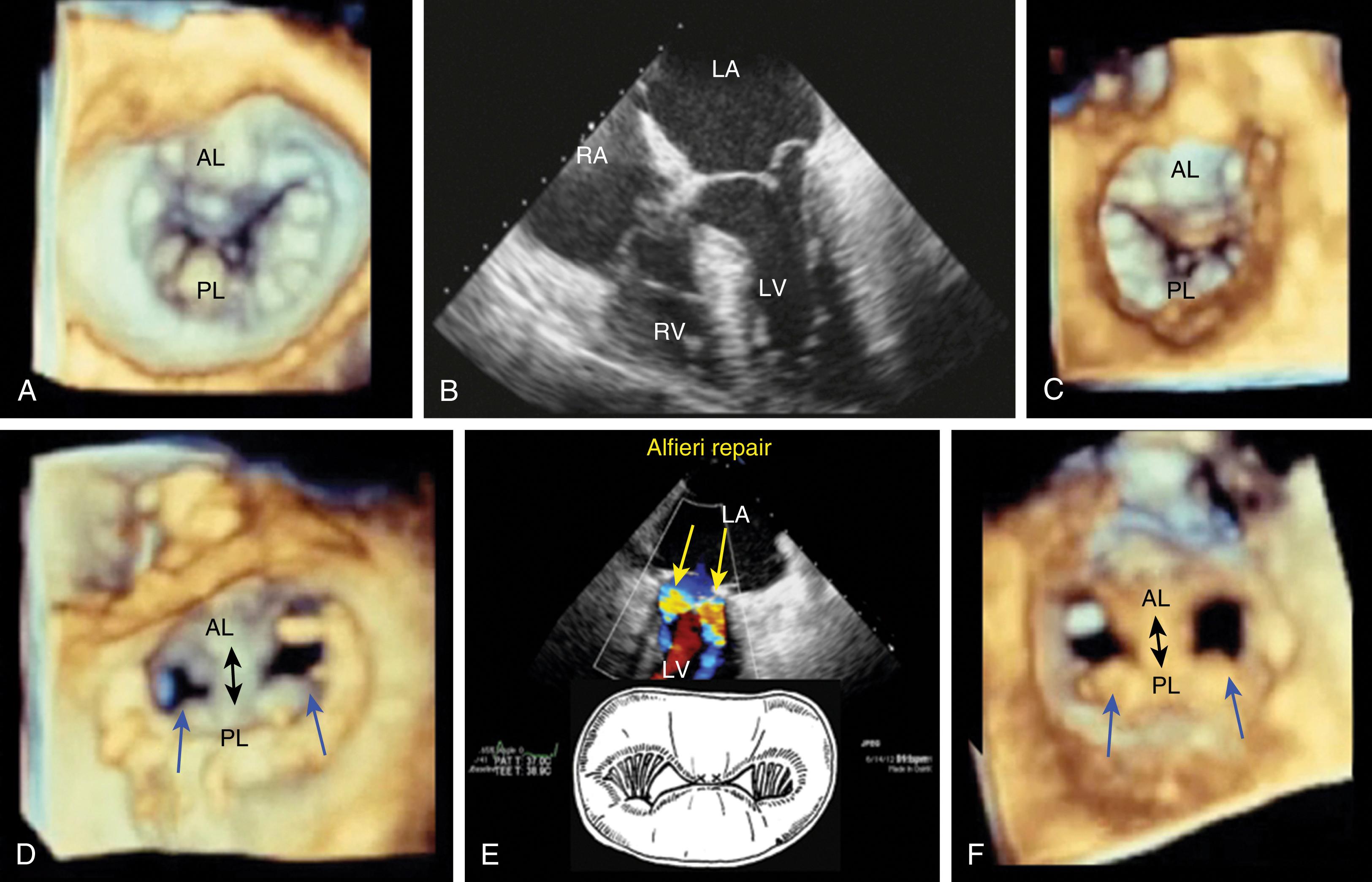 Figure 11.26, Alfieri repair. (A) and (B) The case of a bileaflet prolapse or myxomatous disease is used to demonstrate the Alfieri repair, in which a running suture ( small black arrow in [D] and [F] and middle schematic [E]) is classically placed centrally but may also be placed peripherally. The centrally placed suture creates a figure-of-eight orifice as compared to (A–C) the single orifice. (D–F) After Alfieri repair. Three-dimensional views from (D) the left atrial and (F) ventricular perspectives show a figure-of-eight orifice. (E) Two-dimensional image shows the color Doppler display of two separate jets. AL , Anterior leaflet; LA , left atrium; LV , left ventricle; PL , posterior leaflet; RA , right atrium; RV , right ventricle.