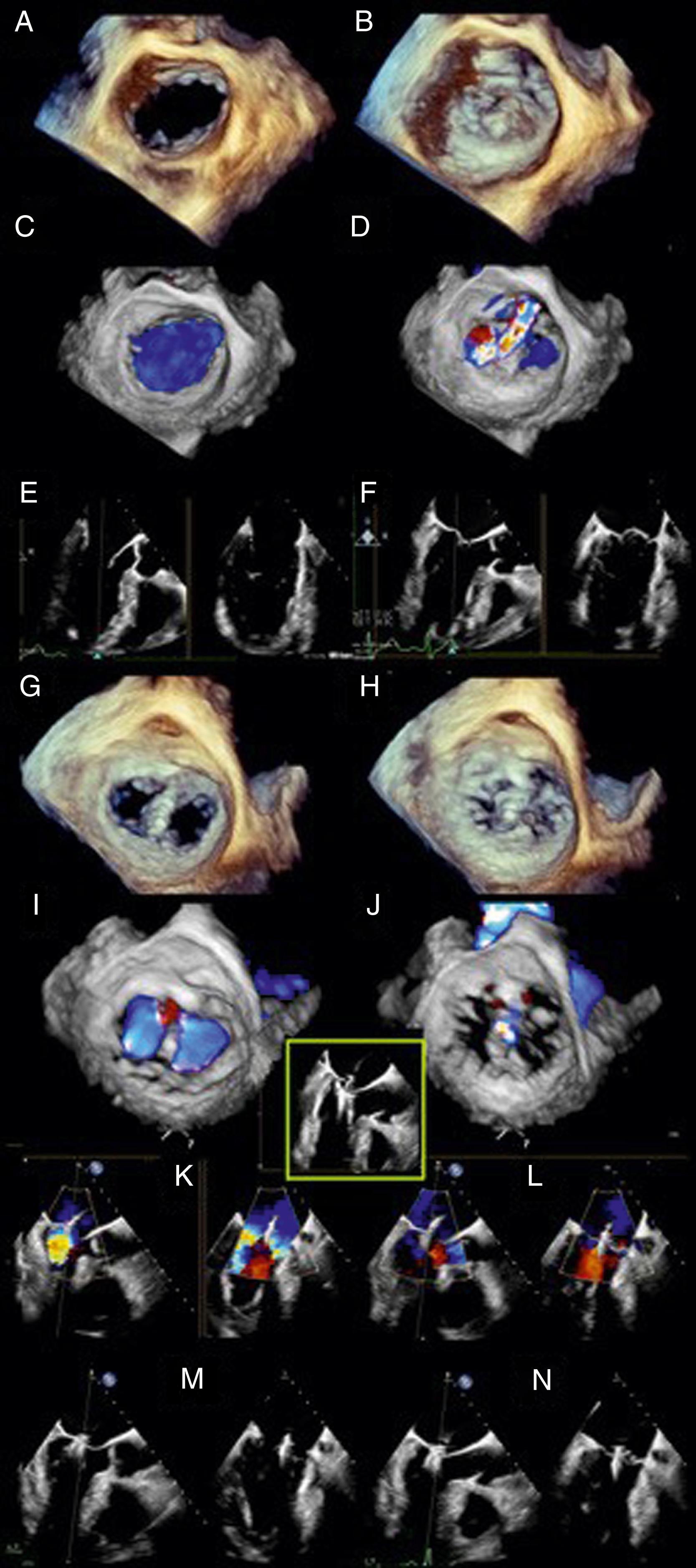 Figure 11.27, MitraClip placement in a patient with posterior prolapse. (A) Three-dimensional (3D) enface mitral valve view in diastole. (B) View in systole, note the prolapsed posterior segment. (C) 3D enface mitral valve view with color flow Doppler in diastole. (D) View in systole, note the anteriorly directed mitral regurgitation jet. (E) Two-dimensional (2D) midesophageal images in diastole. (F) Views in systole. (G) 3D enface mitral valve view post MitraClip placement in diastole, note the double orifice mitral valve opening. (H) View in systole. (I) 3D enface mitral valve view with color flow Doppler in diastole, again note the double orifice mitral opening. (J) View in systole, note the resolution of mitral regurgitation. (K) 2D midesophageal views with color flow Doppler during MitraClip placement in diastole. (L) Views in systole, note the absence of mitral regurgitation. (M) 2D midesophageal views post MitraClip placement in diastole. (N) Views in systole.