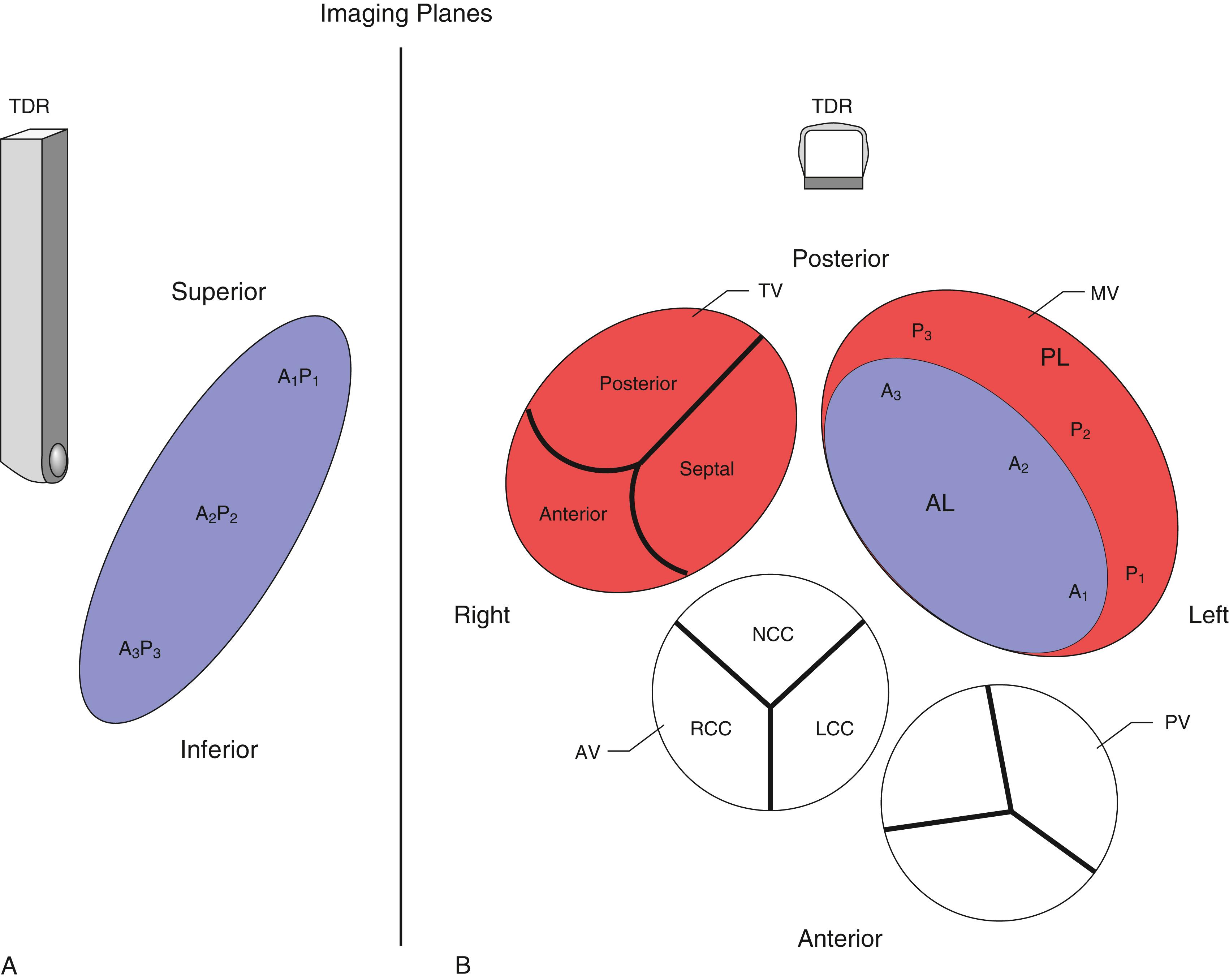 Figure 11.28, Imaging planes. Schematics showing the vertical (A) and horizontal (B) positions of the mitral valve, the latter in relation to other surrounding structures and as would be seen by the transducer positions. A 1 , A 2 , A 3 , Anterior leaflet scallops; AL , anterior leaflet; AV , aortic valve; LA , left atrium; LAA , left atrial appendage; LCC , left coronary cusp (of the aortic valve); LV , left ventricle; NCC , noncoronary cusp; P 1 , P 2 , P 3 , posterior leaflet scallops; PL , posterior leaflet; PV , pulmonary valve; RCC , right coronary cusp; TDR , transducer; TV , tricuspid valve.