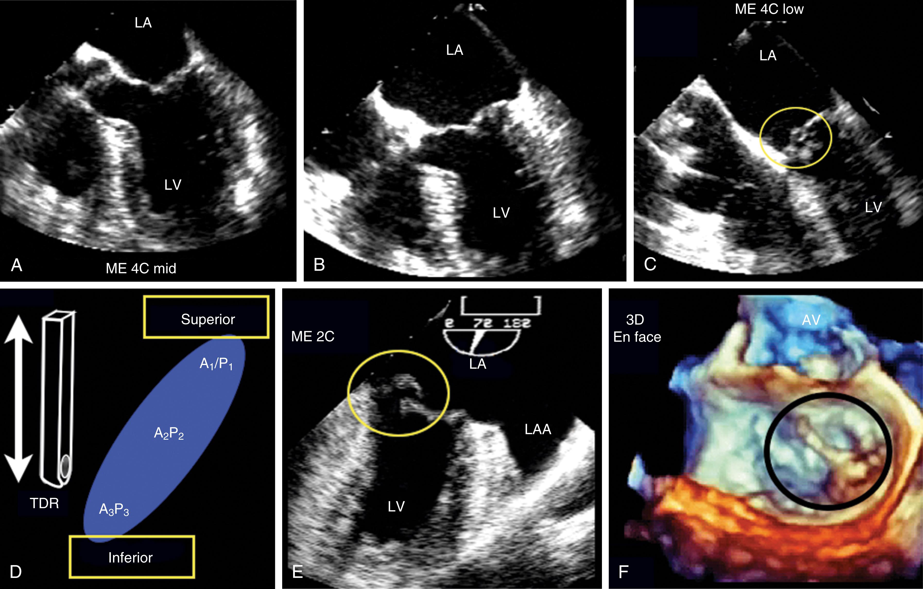 Figure 11.29, P 3 flail: vertical imaging planes (associated with Video 11.1 ). Multiple views of a flail of the posterior (P 3 ) portion of posterior leaflet with a torn chord. (A–C) Images obtained by advancing the transesophageal echocardiography probe from the midesophageal (ME) four-chamber (4C) level to a lower esophageal level, showing the P 3 defect (yellow circle). (D) Schematic showing how the mitral valve also exists in a vertical plane. (E) Lesion (yellow circle) in ME two-chamber (2C) view. (F) Lesion (black circle) in three-dimensional (3D) en face view, showing the defect and the torn chord. A 1 , A 2 , A 3 , Anterior leaflet scallops; AL , anterior leaflet; AV , aortic valve; LA , left atrium; LAA , left atrial appendage; LV , left ventricle; P 1 , P 2 , P 3 , posterior leaflet scallops; PL , posterior leaflet; TDR , transducer.