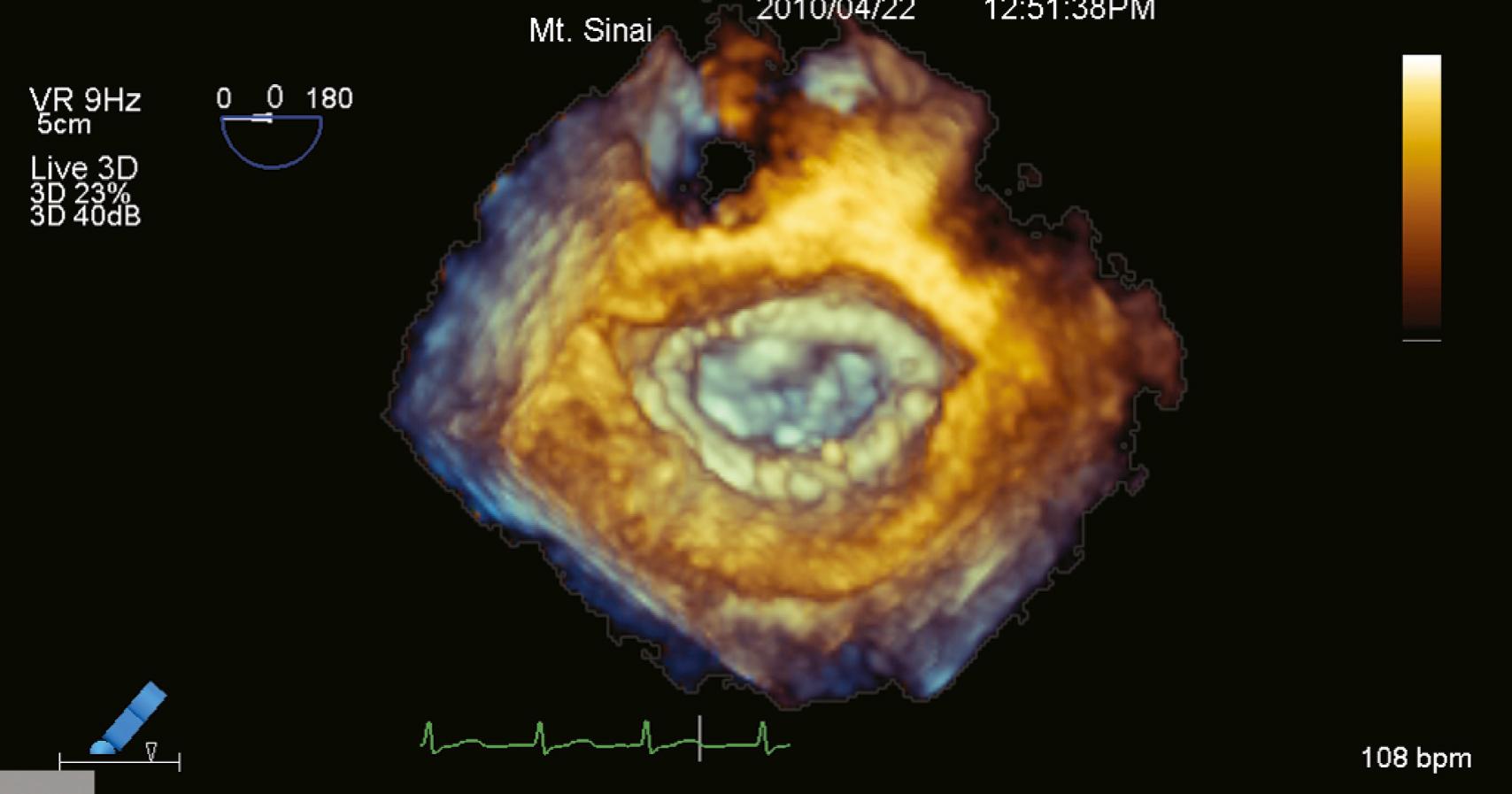 Figure 11.3, Three-dimensional (3D) zoom mode acquisition of a mitral valve repair from the left atrial perspective. Annuloplasty ring is easily visualized. In analogy to the live 3D mode, the 3D zoom mode acquires instantaneous images.