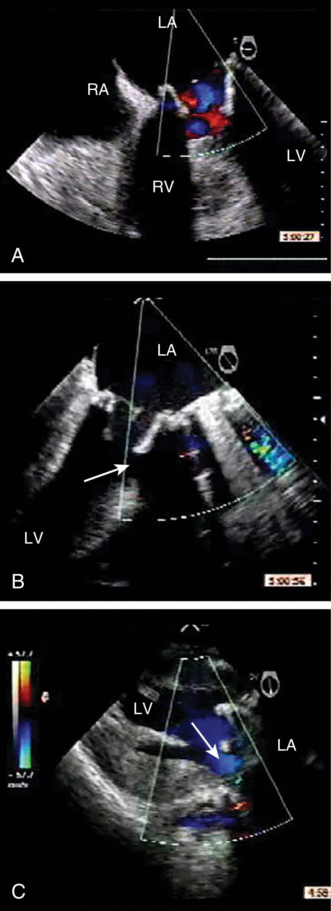 Figure 11.31, Bioprosthetic mitral valve and the left ventricular outflow tract (LVOT). (A) and (B) Midesophageal views of a bioprosthetic valve for which the struts (arrow) appear to be narrowing the LVOT. (C) Transgastric view showing the absence of color Doppler turbulence in the LVOT. Although two-dimensional imaging may be limited, when complemented by Doppler technology, the examiner can adequately formulate a clinical impression and diagnosis. Arrow points to color flow. LA , Left atrium; LV , left ventricle; RA , right atrium; RV , right ventricle.