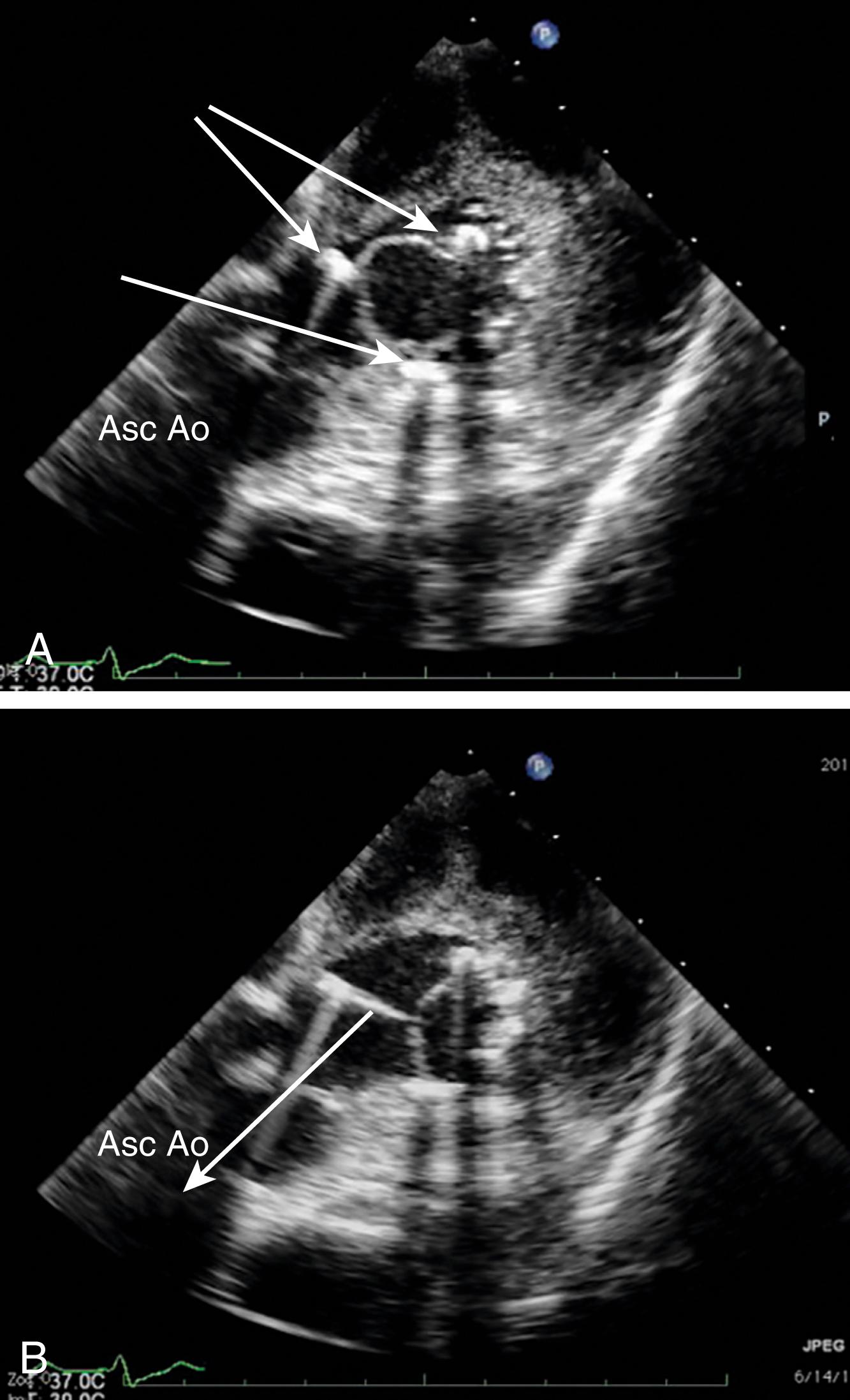 Figure 11.32, Bioprosthetic mitral valve: transgastric (TG) imaging. This is an example of how a comprehensive examination yields greater information during this two-dimensional imaging from a TG window. (A) Mitral bioprosthetic valve with struts (white arrows) not in the left ventricular outflow tract (LVOT). (B) White arrow shows an unhindered path through the LVOT and across the aortic valve. Asc Ao , Ascending aorta.