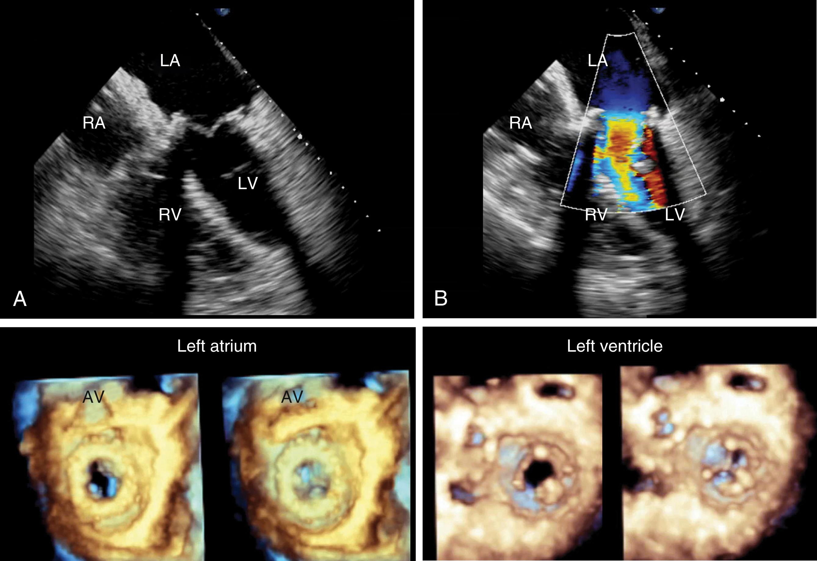 Figure 11.34, Normal functioning bioprosthetic mitral valve: three-dimensional (3D) imaging. (A) and (B) Normal two-dimensional and Doppler findings of a bioprosthetic valve. Lower images show 3D views of the valve from the LA during diastole and systole from the left atrial (left two images) and left ventricular (right two images) perspectives. LA , Left atrium; LV , left ventricle; RA , right atrium; RV , right ventricle.