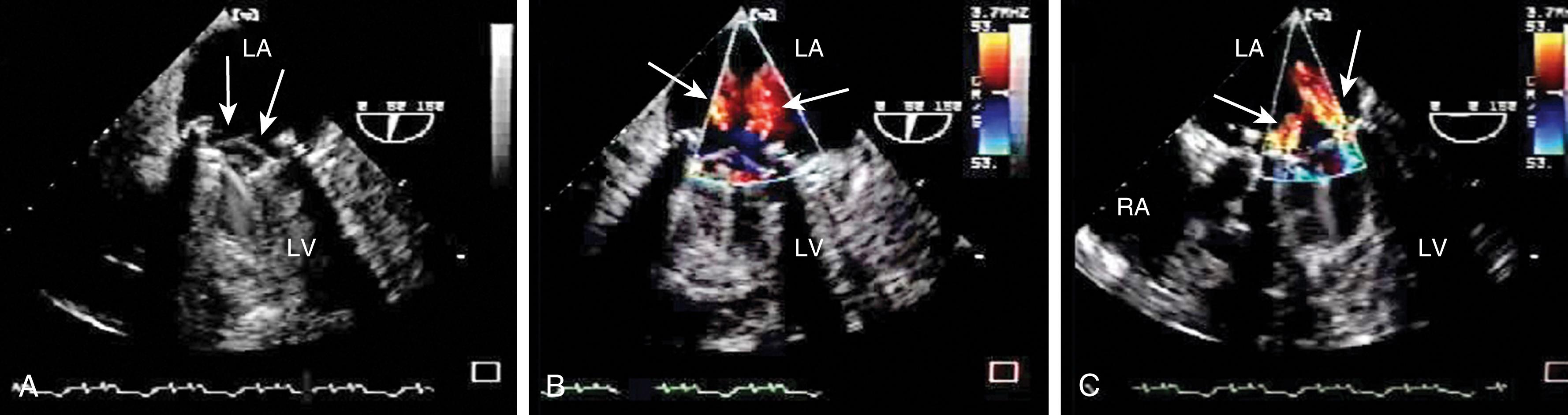 Figure 11.36, Normal mechanical mitral valve. Images obtained during ventricular systole. (A) and (B) are perpendicular to the valve leaflets, and, while two regurgitant jets (arrows) appear in color Doppler imaging, the origin and direction of the two jets are in question. (C) was obtained parallel to the leaflets and more clearly demonstrates the two inwardly directed washing jets (arrows) associated with this valve. LA , Left atrium; LV , left ventricle; RA , right atrium; RV , right ventricle.