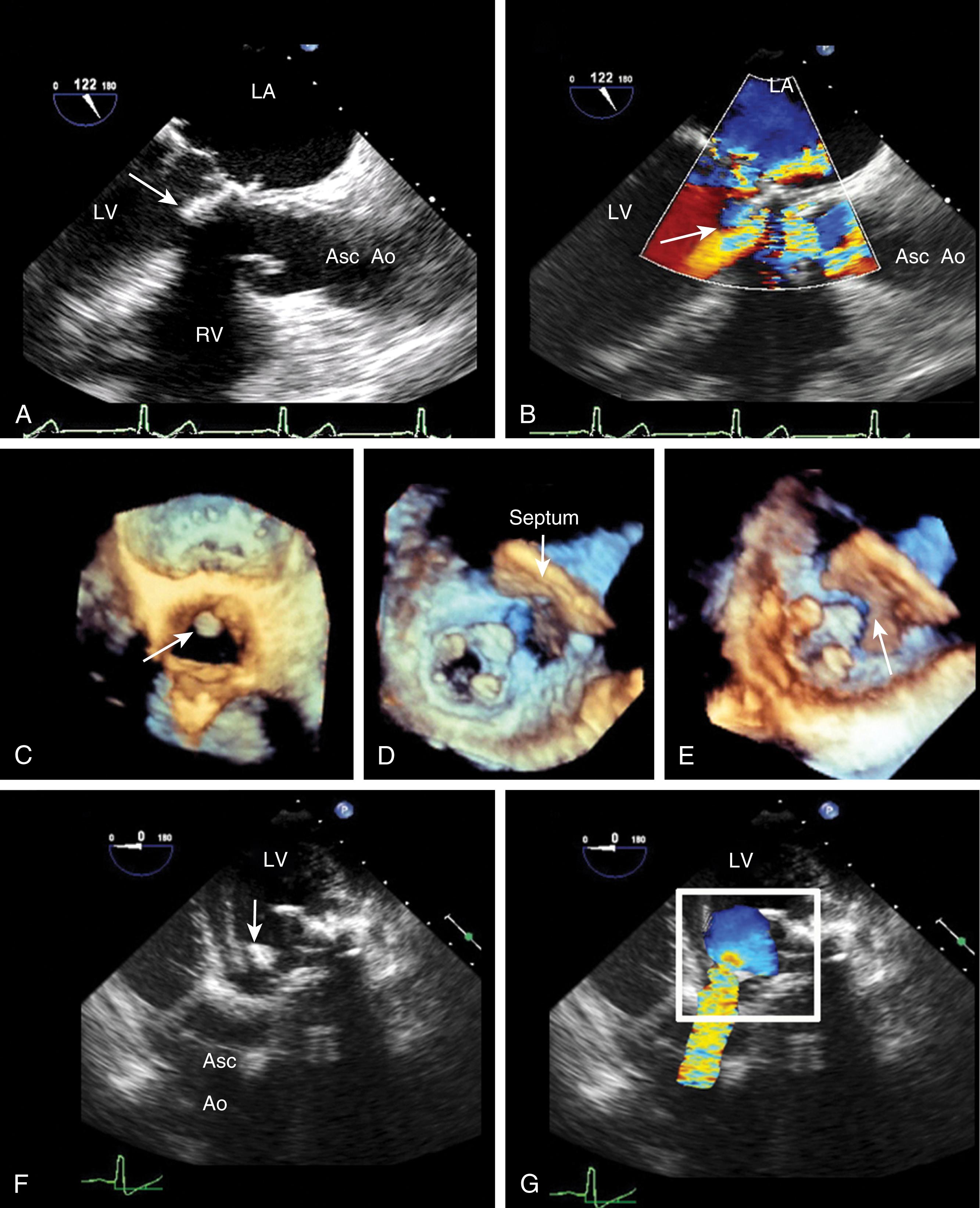 Figure 11.38, Imaging of the bioprosthetic mitral valve in relation to the left ventricular outflow tract (LVOT). (A) Two-dimensional (2D) and (B) color Doppler midesophageal long-axis views, showing the strut (arrow) of a bioprosthetic valve in close proximity to the LVOT. The color Doppler image shows turbulence (black arrow) in the LVOT. Three-dimensional views from (C) the aortic side of the aortic valve and from the LV perspective in (D) diastole and (E) systole. (D) shows a circular appearing echo density (arrow) on the LVOT side This is the tip of the more anterior prosthetic strut in close proximity to the LVOT. (E) During systole the anterior strut (arrow) of the bioprosthetic valve is in close proximity to the ventricular septum. (F) 2D and (G) color Doppler images from transgastric windows, showing both proximity of the strut (arrow) to the LVOT and color Doppler turbulence at this site. (G) The narrowing is significant enough to create flow convergence (white box). Asc Ao , Ascending aorta; LA , left atrium; LV , left ventricle; RA , right atrium; RV , right ventricle.