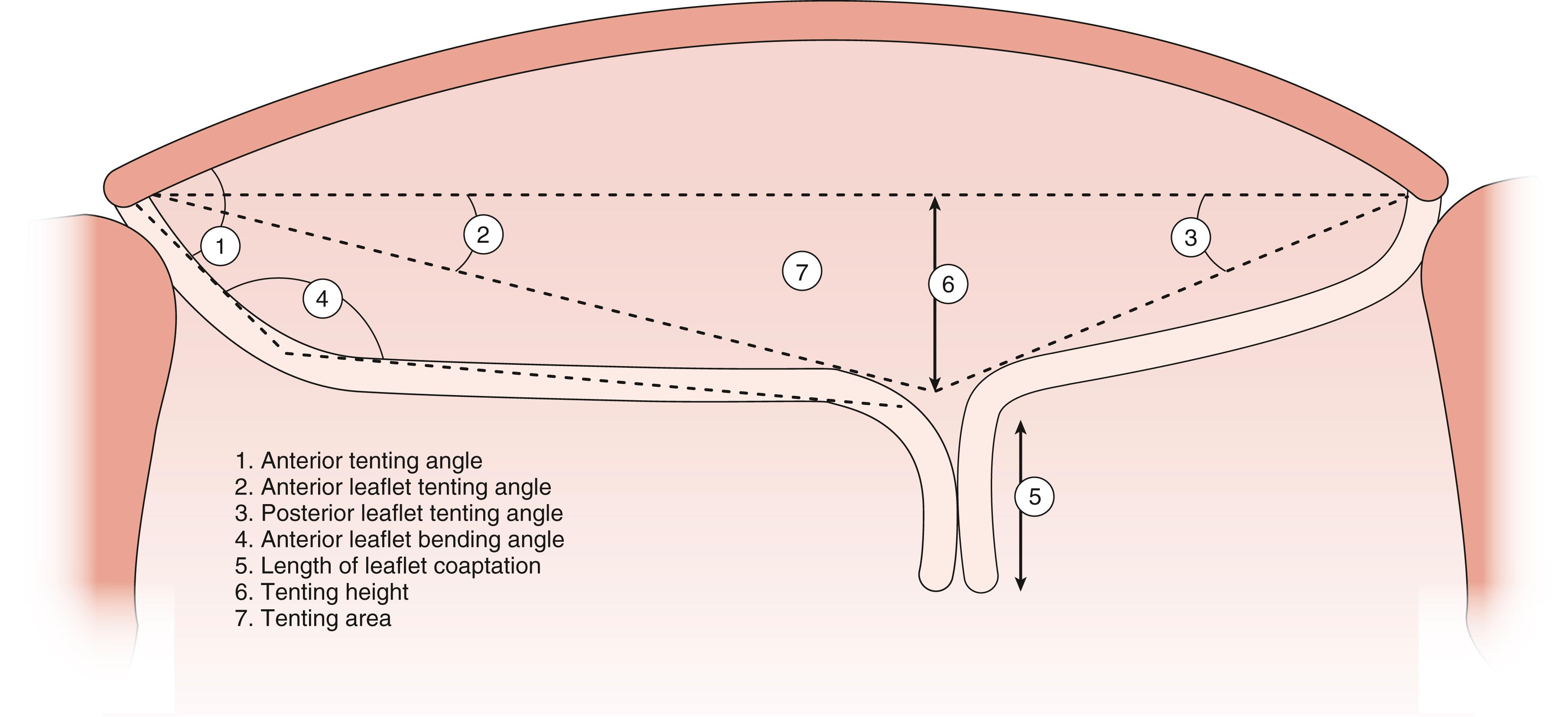 Figure 11.40, Functional mitral regurgitation (MR): annular measurements. Although these seven annular measurements can be useful for all types of MR, they are particularly relevant for patients with functional MR as they highlight the extent of change in the mitral apparatus resulting from ventricular remodeling. Increases in all measures except for number 5 (coaptation zone or length) result from ventricular remodeling described by apical and lateral displacement of the papillary muscles and resultant tethering of the mitral leaflets. When this happens, the coaptation length or zone decreases in the valve becomes incompetent.