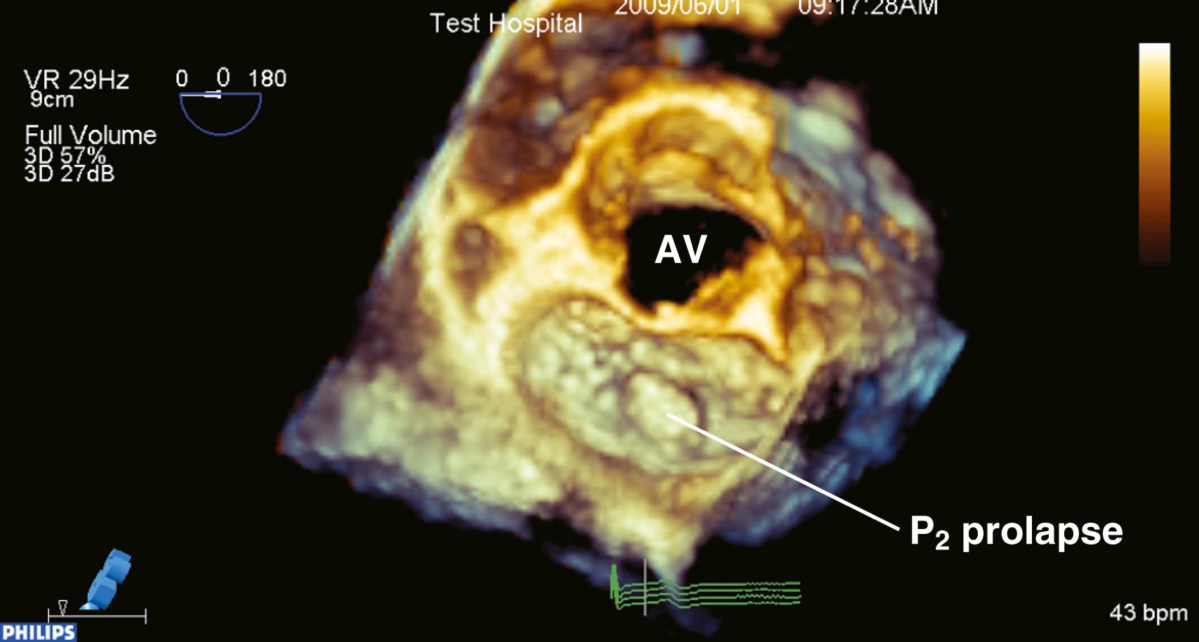 Figure 11.4, Full-volume mode acquisition of the mitral valve from the left atrial perspective. The improvement in temporal resolution is a consequence of the four-beat acquisition (9 vs 29 Hz). This mode does not permit instantaneous live imaging. AV , Aortic valve.