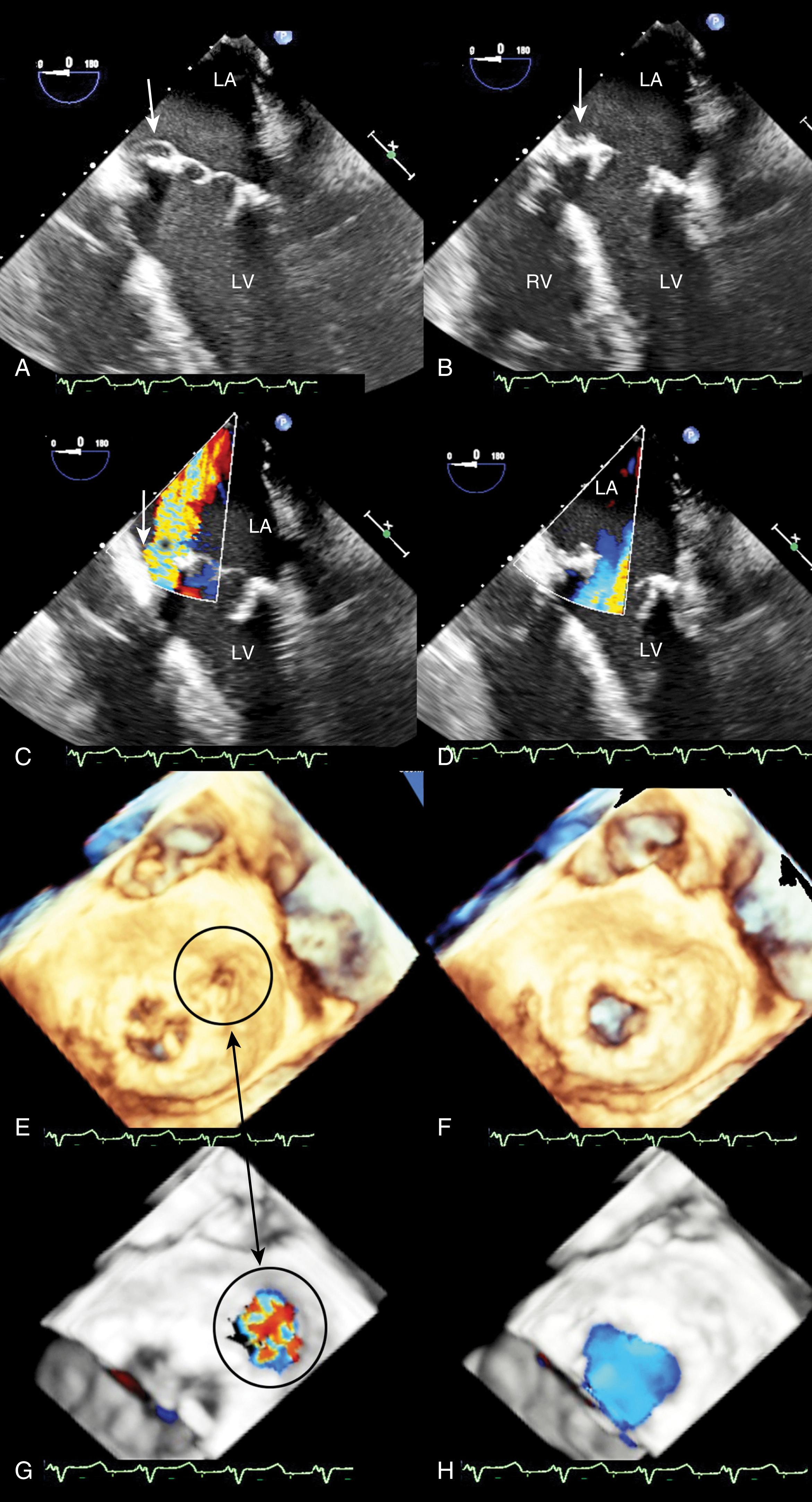 Figure 11.43, Large paravalvular leak following mitral valve replacement. Large paravalvular regurgitant jet along the septal border (white and black arrows) of the prosthetic valve during (A and C) systole and (B and D) diastole. (C) Large jet of regurgitation. (E–H) The defect (black circle) is further qualified (and subsequently quantified) in three-dimensional imaging during systole (E) and (F). (F) and (H), obtained during diastole, show that the defect is not seen. LA , Left atrium; LV , left ventricle; RV , right ventricle.