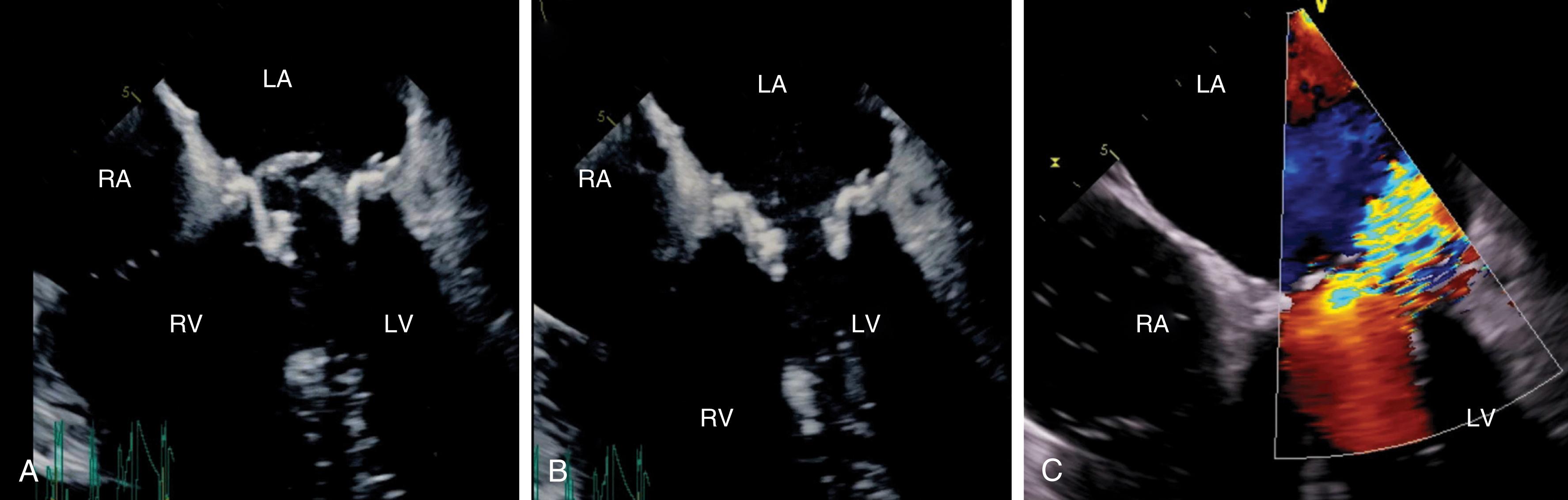 Figure 11.44, Prosthetic valve endocarditis. (A) and (B) A mobile (above the annular plane) echodensity seen during systole on this bioprosthetic valve is associated with (C) significant mitral regurgitation. LA , Left atrium; LV , left ventricle; RA , right atrium; RV , right ventricle.