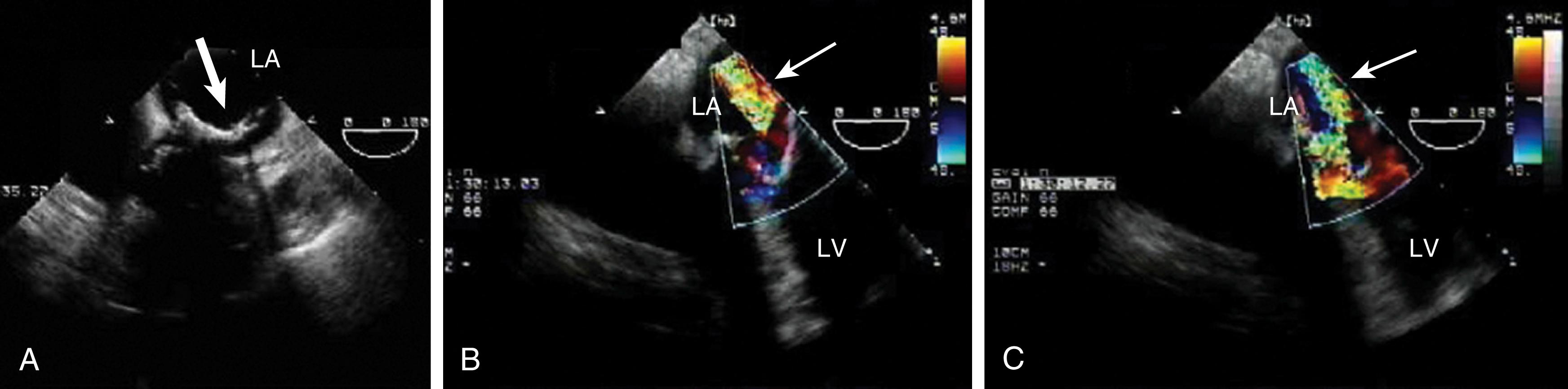 Figure 11.45, Bioprosthetic valve dehiscence along the posterior mitral annulus. (A) Echo clear (arrow) space below the annular prosthesis with advancement of the transesophageal echocardiography probe. (B) and (C) Associated severe mitral regurgitation (white arrow). LA , Left atrium; LV , left ventricle.