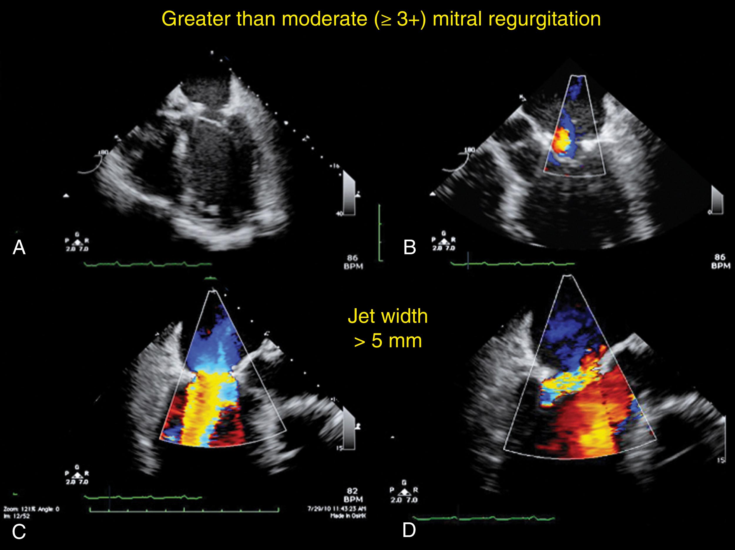 Figure 11.46, Mitral regurgitation (MR) assessment immediately after mitral valve repair. (A) and (B) Leaflets are seen in the closed position with (B) a mild amount of MR. (C) and (D) Follow-up shows (D) a significant amount of MR defined by a jet width greater than 5 mm.