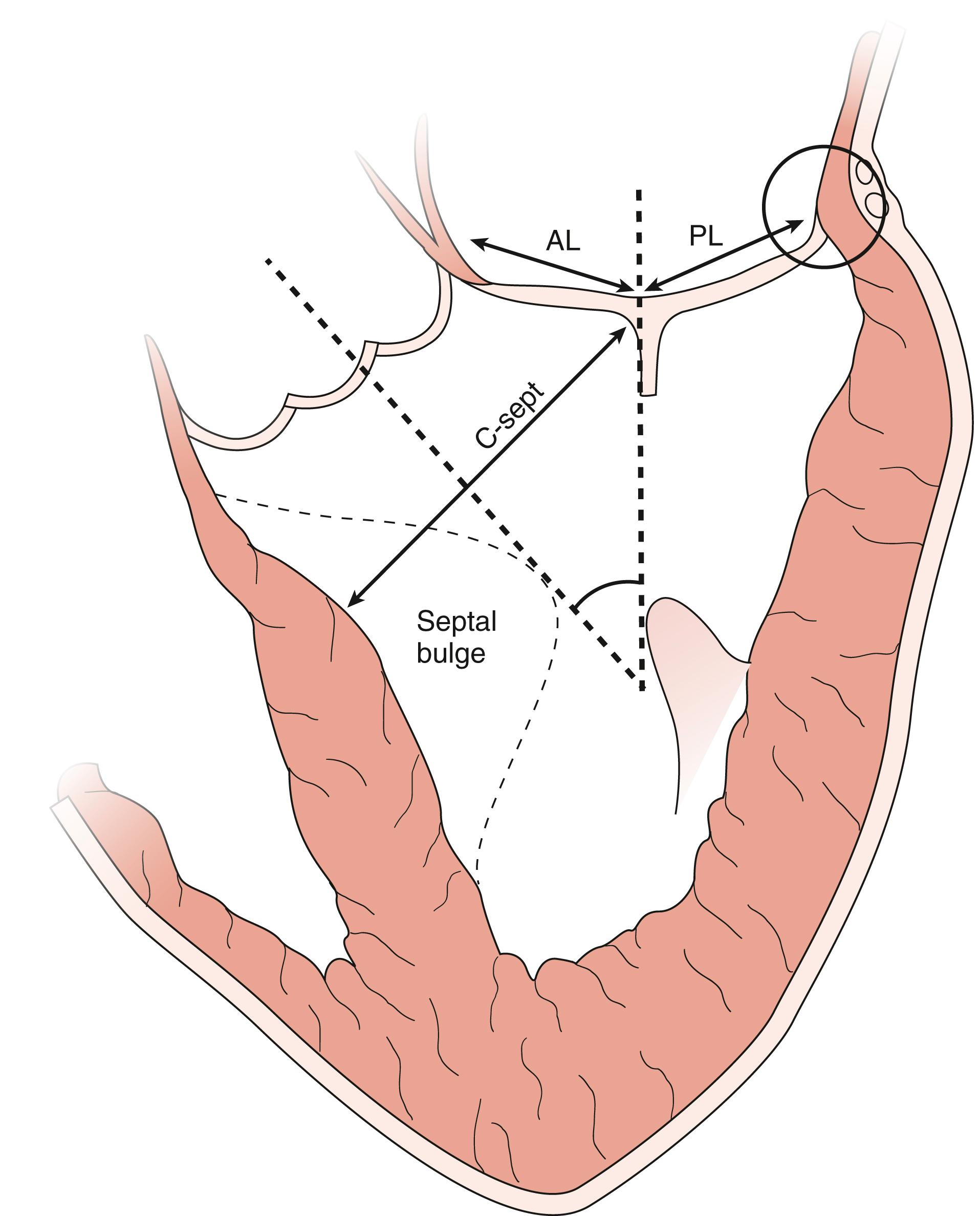 Figure 11.47, Predictors of systolic anterior motion (SAM). While a greater number of predictors of SAM have been described, the schematic highlights six that seem to be more commonly encountered and/or described. The ratio and heights of the anterior (AL) and posterior (PL) leaflets contribute toward a greater amount of slack leaflet portions in closer proximity to the left ventricular outflow tract (LVOT). This may also be seen as a shorter distance between the coaptation point and the ventricular septum (C-sept). The presence of a prominent septal bulge also narrows the LVOT, which brings the mitral leaflets closer and/or creates higher jet velocity, which might create a Venturi effect to drag the slack mitral leaflet portions toward the LVOT. The mitral inflow: aortic outflow angle (right dotted lines) might describe an anatomy that either brings the leaflet tips closer to the LVOT or one that affects transmitral and subsequent intraventricular flow directions such that systolic outflow may (with a greater angle) interact more with mitral leaflets. Finally, impairment of the normal annular systolic motion may decrease the LVOT area and the distance between the mitral leaflets and the LVOT. The black circle around the posterior and lateral annulus represents calcification of the annulus and a reduction in posterior and lateral annular contraction.