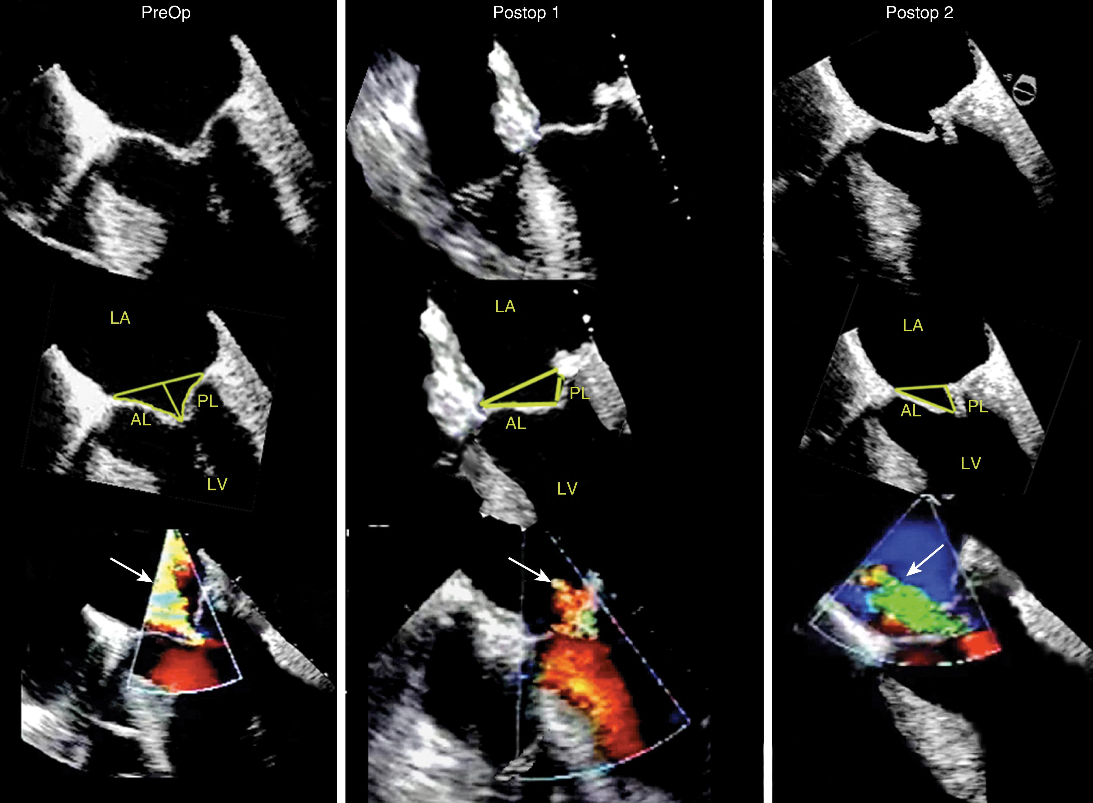 Figure 11.48, Repair of type IIIb mitral regurgitation (MR): annuloplasty. This case shows the preoperative, intraoperative, and second preoperative (reoperation) echocardiographic images. The preoperative images show the tethered leaflets (yellow triangle, middle figure) and MR (white arrow, lower image). After placement of an annuloplasty ring, the intraoperative images show a reduced tethering (yellow triangle, middle image) with reduced MR (white arrow). As is reported with repair of type IIIb MR, the images to the right show the recurrence of MR (white arrow). AL , Anterior leaflet; LA , left atrium; LV , left ventricle; PL , posterior leaflet.