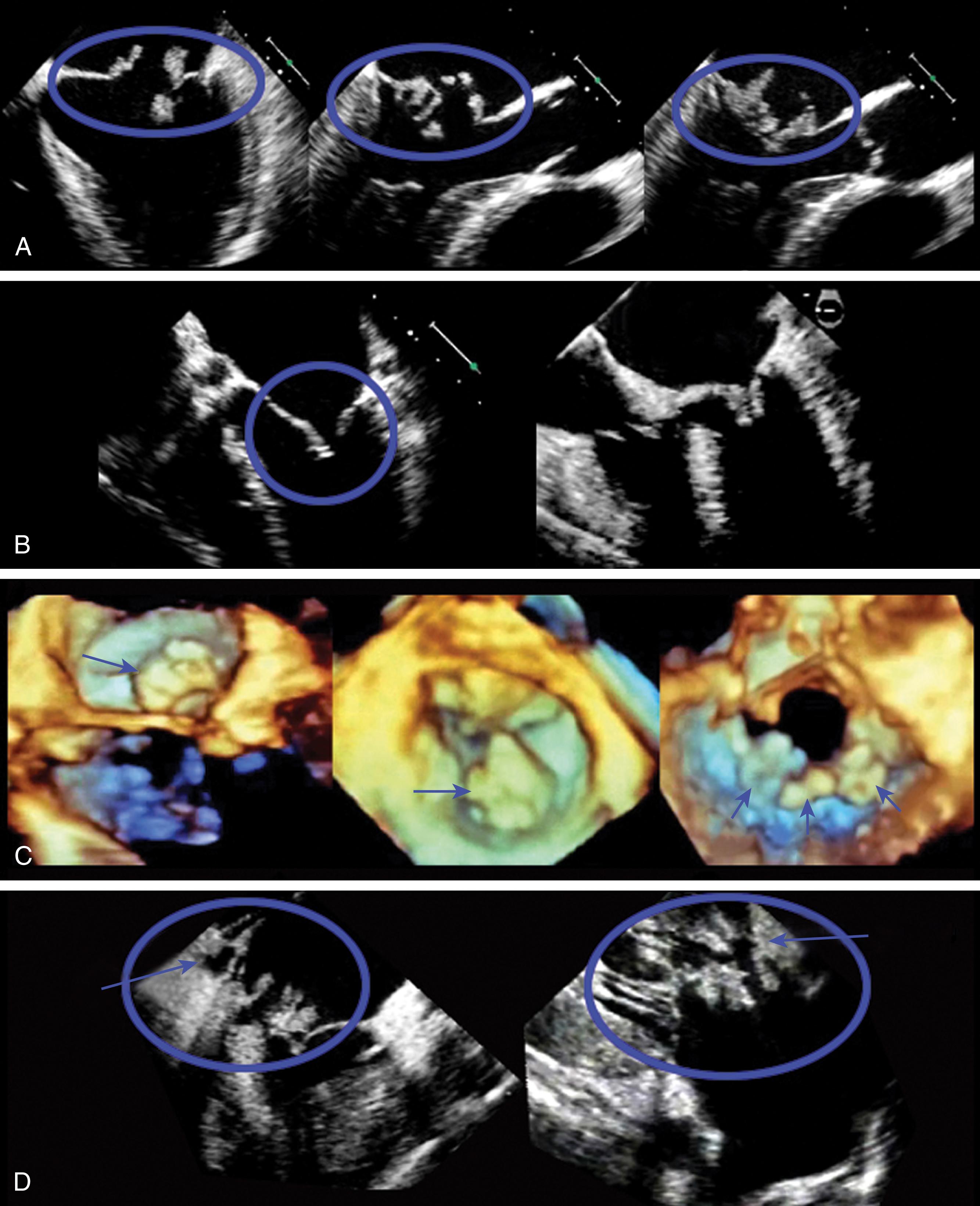 Figure 11.49, Difficult repair or no repair examples. Although not an absolute contradiction to repair, extensive infection increases the difficulty of repair and reduces the long-term durability. (A) Extensive leaflet destruction. (B) Rheumatic velvets; typically replaced as the risk of mitral regurgitation recurrence and reoperation is high (approximately 25%). (C) Three-dimensional images highlighting extensive annular calcification (blue arrows). (D) Significant leaflet destruction and annular involvement.