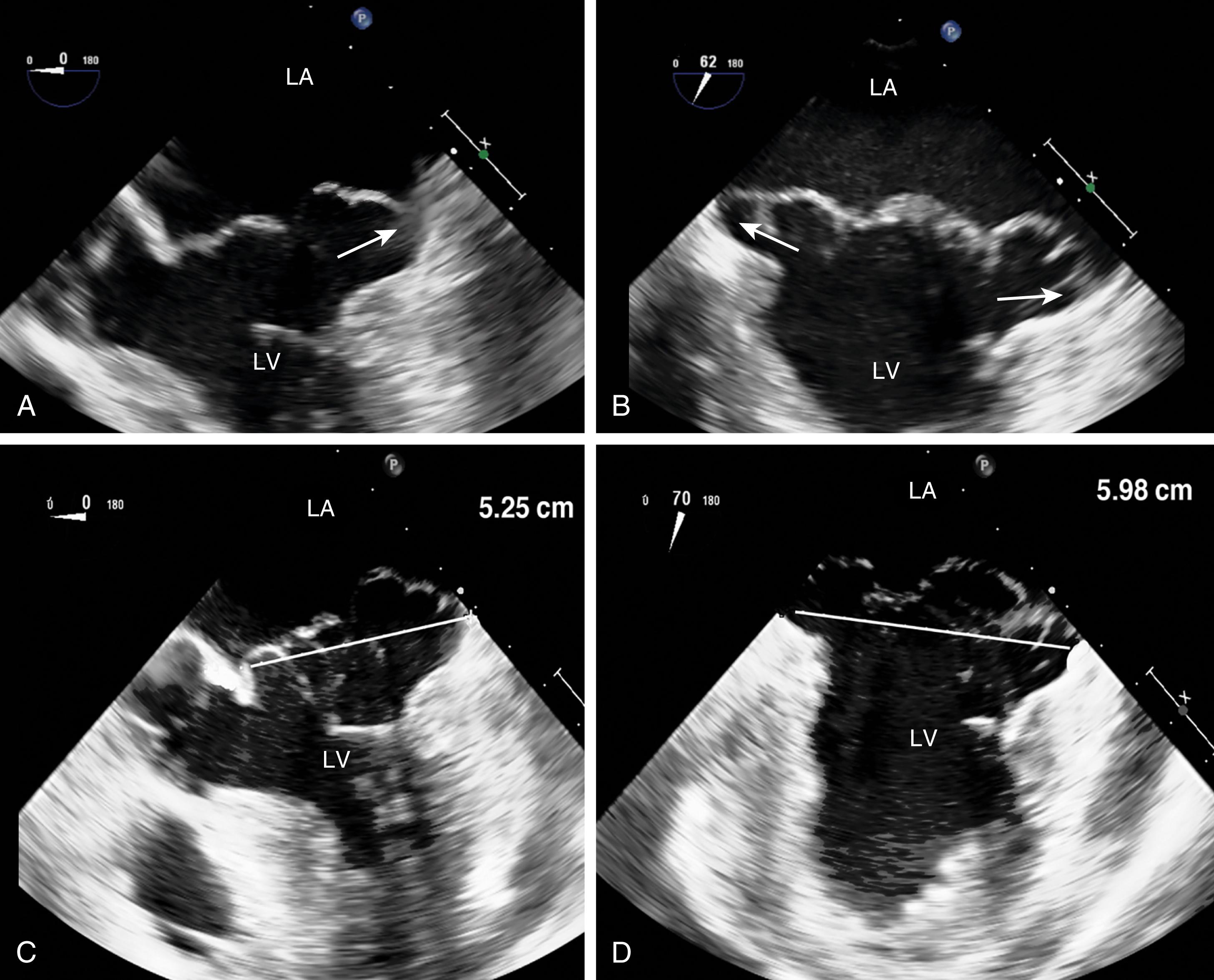 Figure 11.50, End-stage or atrialization of mitral leaflets. (A–D) Significant bileaflet prolapse, as well as the appearance of atrialization of the leaflet insertion (arrows). When coupled with severe annular enlargement (5.25 cm), these findings are consistent with severe, perhaps late-stage myxomatous disease, with all findings suggesting a difficult repair with questionable durability. LA , Left atrium; LV , left ventricle.