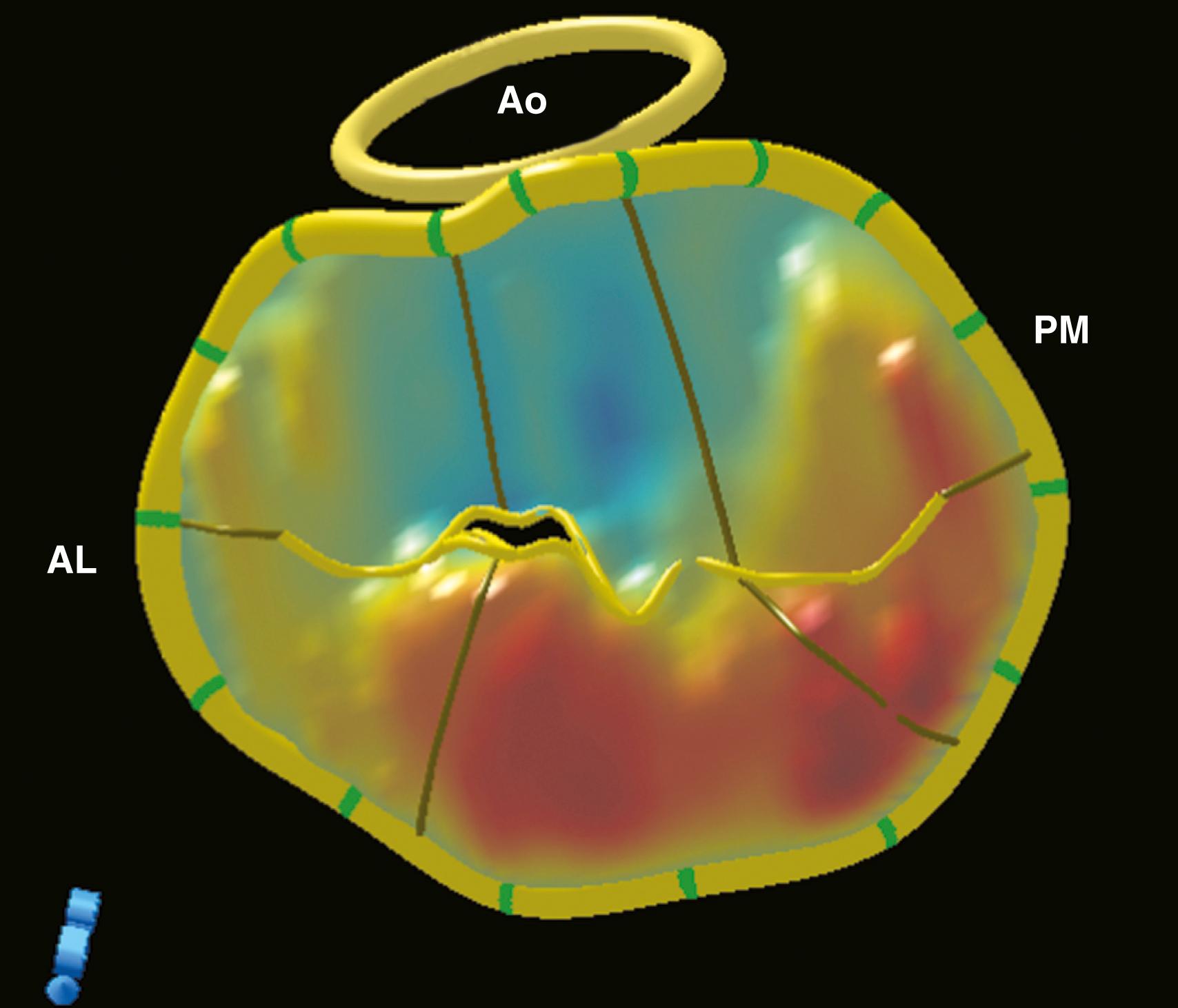 Figure 11.5, Mitral valve quantification acquired with the full-volume mode. Red coloring of the leaflet indicates areas that exceed the annular plane (type II dysfunction). AL , Anterolateral; Ao , aorta; PM , posteromedial.