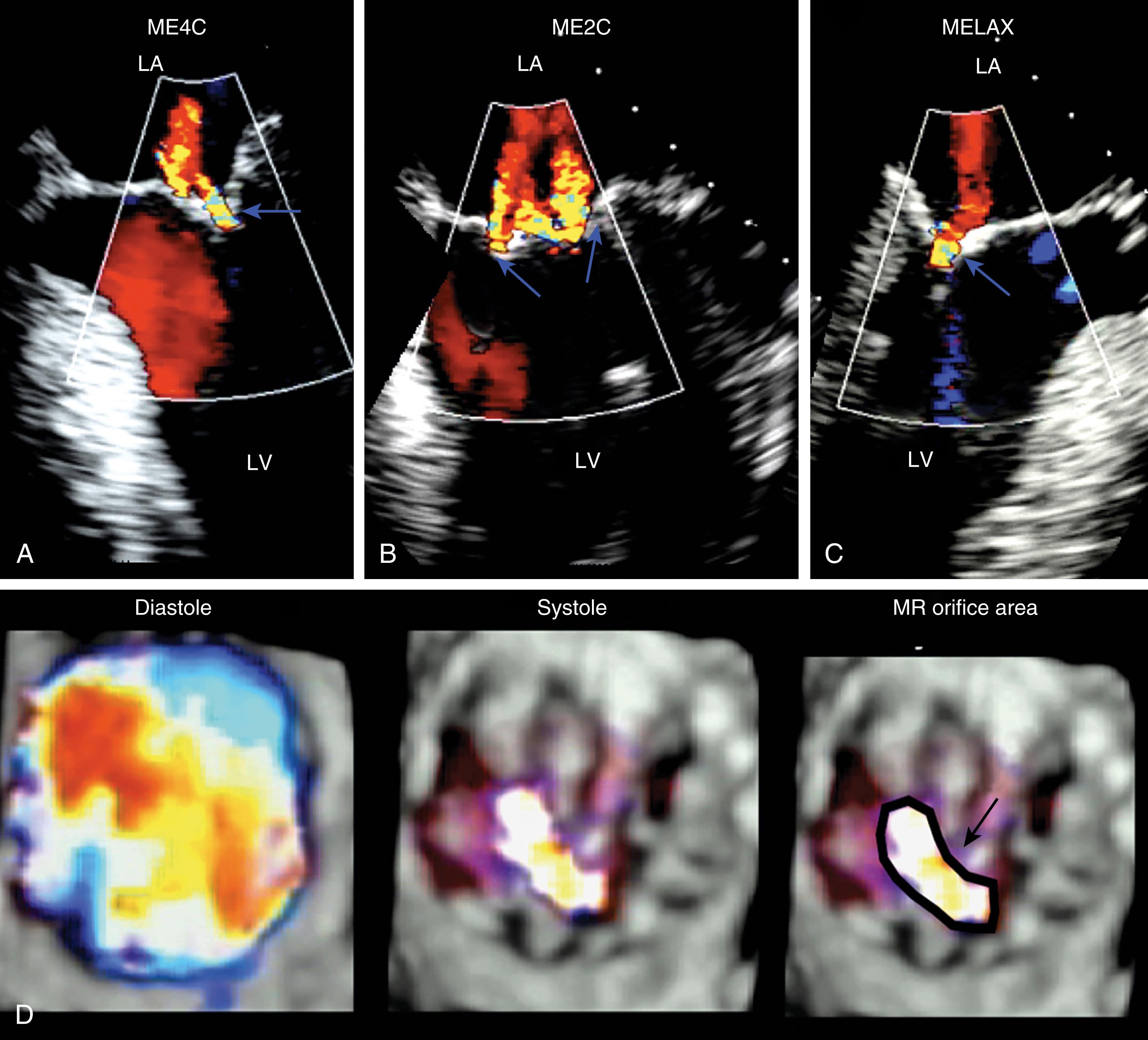 Figure 11.51, Three-dimensional (3D) image of the regurgitant orifice. (A–C) Two-dimensional appearances of the same mitral regurgitant jet from three different midesophageal (ME) echocardiographic windows: four-chamber (4C) , two-chamber (2C) , and long-axis (LAX) , respectively. Vena contracta measurements from the ME4C and MELAX views are more accurate correlates of mitral regurgitation (MR) severity as they measure perpendicular to the MR jet, while the ME2C window views parallel to the MR jet. (D) This is confirmed using 3D imaging of the regurgitant jet during diastole (left) and systole (middle) from the left ventricular (LV) perspective. The shape of the regurgitant orifice, during systole on the right , is elliptical. The implications are that the effective regurgitant orifice is not circular and the flow convergence (proximal isovelocity surface area [PISA]) is not hemispherical as the principle behind the equation assumes it to be, creating errors in the PISA method. 3D imaging, when feasible, allows a direct measure of the regurgitant orifice area shown in black (right) .