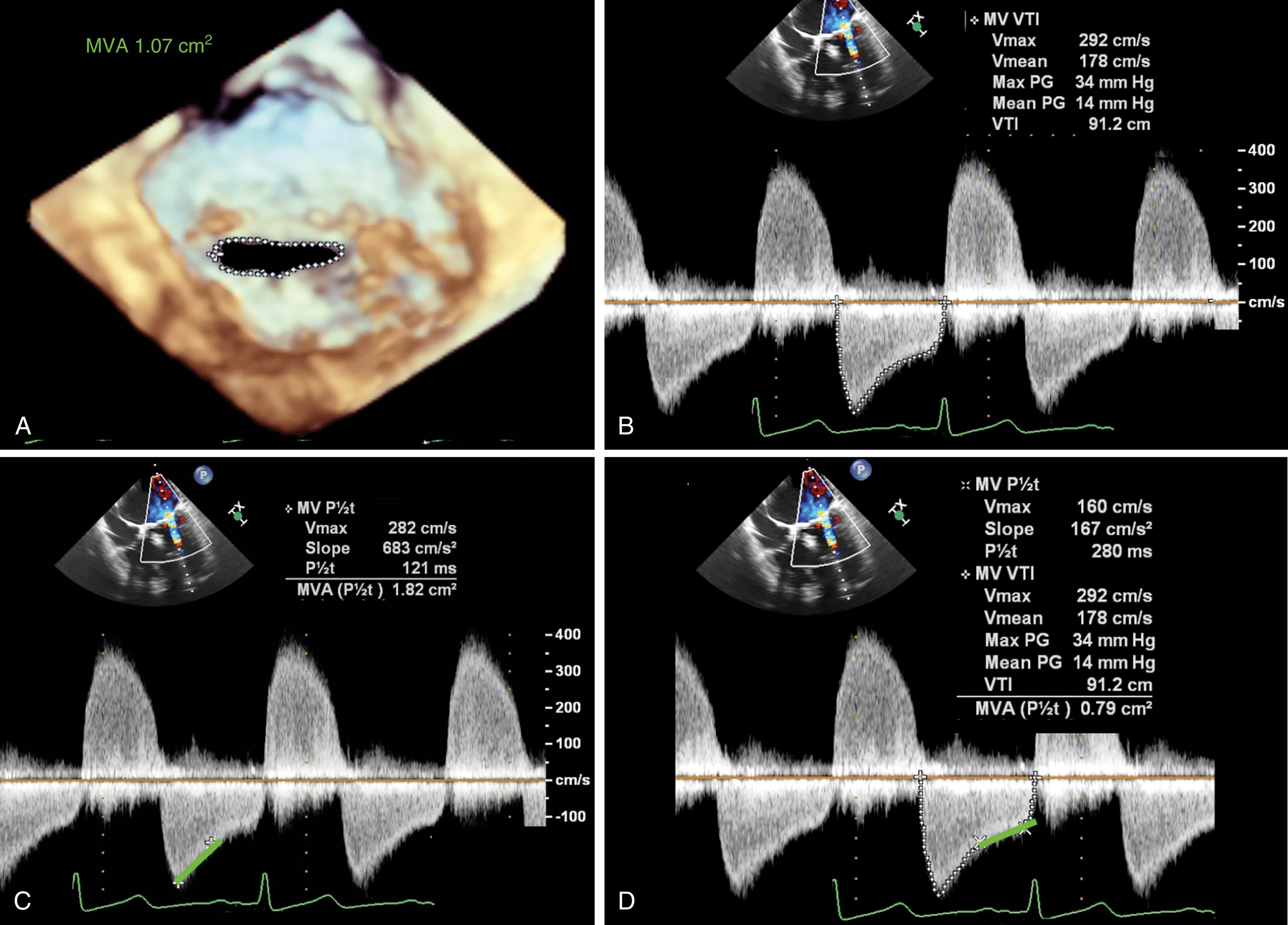 Figure 11.54, Assessment of mitral stenosis (MS). Pressure gradients, pressure half-time (PHT), and planimetry are the common assessments of the mitral valve area (MVA) . (A) Planimetry is performed from the three-dimensional view of the mitral opening seen from the left ventricular perspective. (B–D) Doppler profiles of flow across the valve. It is evident that mitral regurgitation coexists as seen by the upward systolic flow. Based on the downward deflection, MS also exists. The peak and mean gradients are 34 and 14 mm Hg, respectively. The forward flow profile across the valve, however, is biphasic. If the PHT were based on the initial phase, the MVA would be 1.82 cm 2 . However, if based on the latter phase, the MVA would be 0.79 cm 2 . Since the initial phase may represent initial opening velocity resistances, flow, and cardiac output, it is recommended to use the latter phase because it represents a more stable flow state and a better reflection of the effective orifice area.