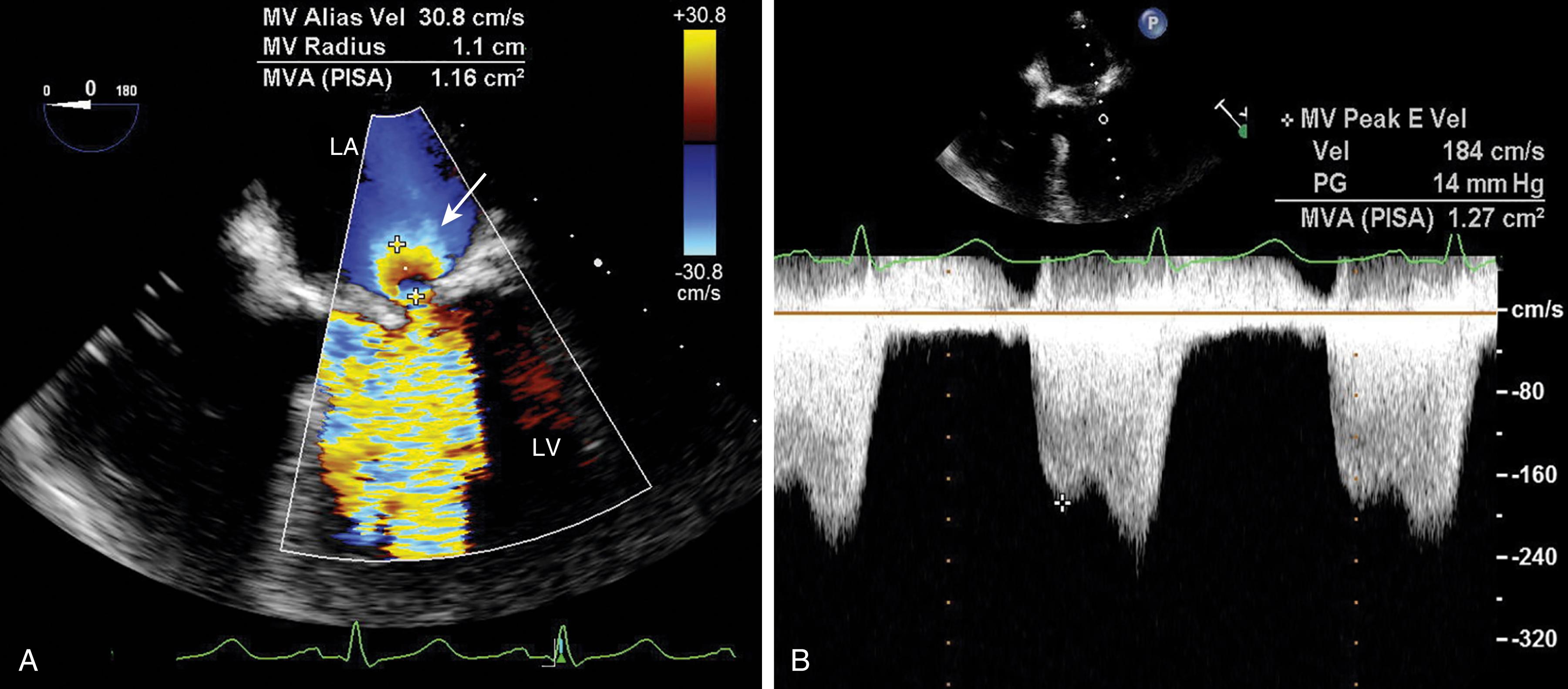 Figure 11.55, (A) Mitral valve area (MVA) with proximal isovelocity surface area (PISA) . Flow through a relatively narrow orifice results in flow convergence. This can be the case for stenotic valves as well as regurgitant valves. (B) The PISA method to assess effective orifice area can be employed to calculate the stenotic orifice in the same way it is used to calculate a regurgitant orifice. As shown in this figure, the MVA is approximately 1.30 cm 2 . LA , Left atrium; LV , left ventricle.