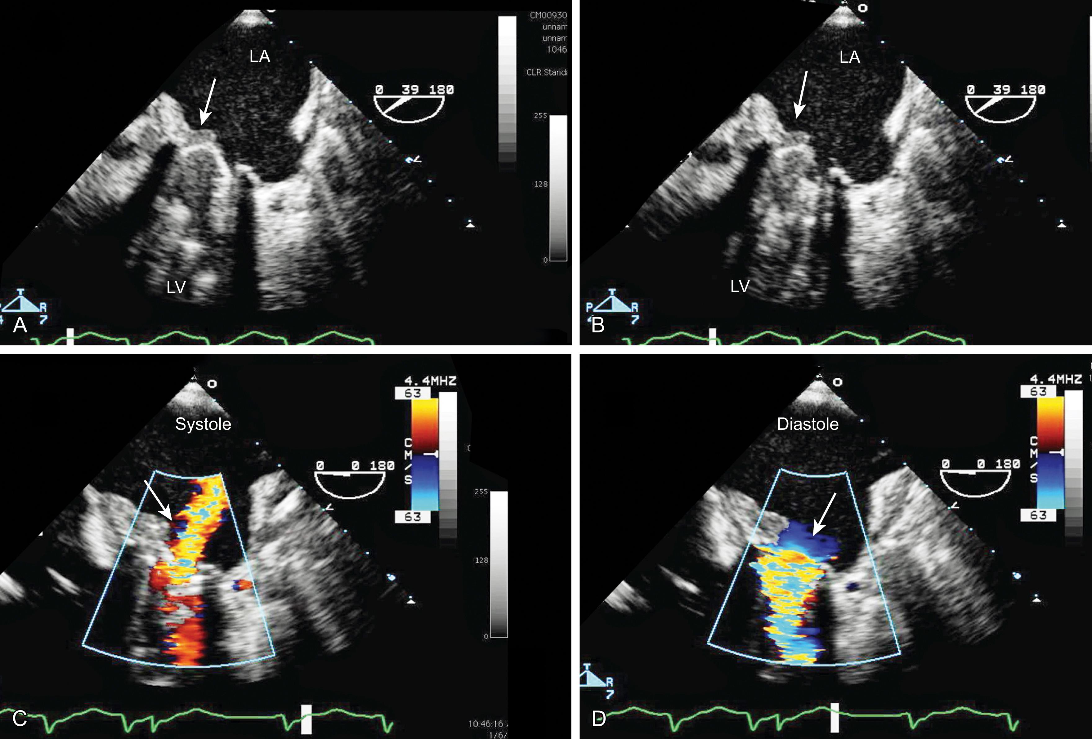 Figure 11.56, After mechanical mitral valve replacement: stuck leaflet: thrombus. Stuck mechanical leaflet of a bileaflet mechanical valve in the mitral position, probably the result of thrombus. The medial leaflet (white arrow) appears to be stuck in a closed position and surrounded by thickening consistent with thrombus formation shown in (A) systole and (B) diastole. Color Doppler imaging demonstrates turbulent flow consistent with both (C) regurgitation and (D) stenosis. LA , Left atrium; LV , left ventricle.