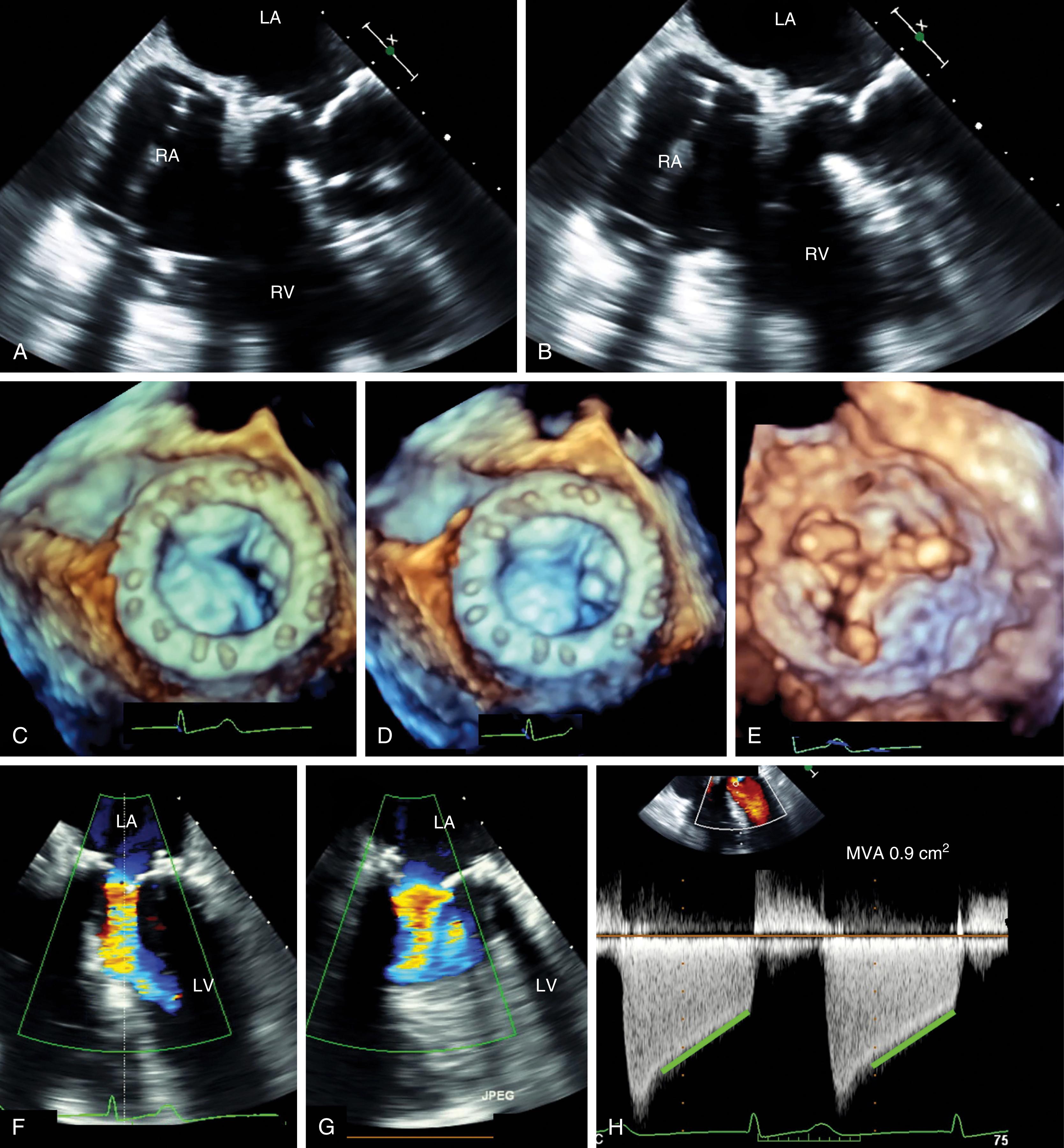 Figure 11.57, After bioprosthetic mitral valve replacement: degeneration/thickening/restriction. These images demonstrate a complication of bioprosthetic valves in that the leaflets, likely due to inflammation, are thickened, less compliant, and less mobile. This case demonstrates significant mitral stenosis. (A) and (B) Two-dimensional images show echo-bright thickened and immobile prosthetic leaflets during both diastole (left) and systole (right). (C) Three-dimensional image showing a very small opening in diastole from the left atrial perspective. (D) Valve in systole. (E) Three-dimensional image showing a very small opening in diastole from ventricular perspective. (F) and (G) Turbulent forward flow during diastole compared with stenosis and confirmed by (H) the continuous-wave Doppler profile. LA , Left atrium; LV , left ventricle; MVA , mitral valve area; RA , right atrium; RV , right ventricle.