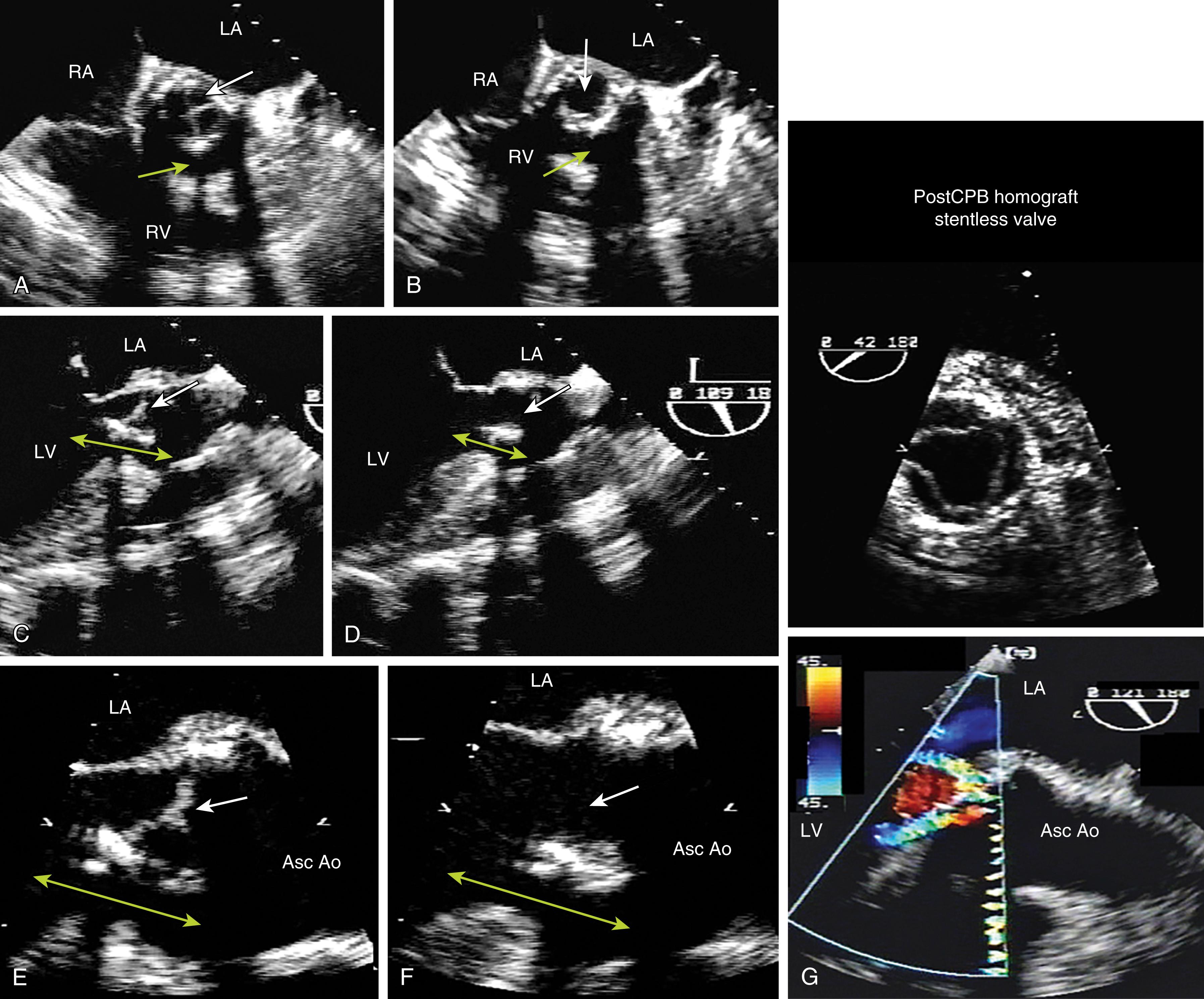 Figure 11.62, Aortic bioprosthesis dehiscence. Multiple images of a normally functioning bioprosthetic valve that has separated from the anterior part of the native annulus (ie, dehiscence). (A), (C), and (E) were obtained during diastole and (B), (D), and (F) during systole. The yellow arrows point to the site of dehiscence. (G) Complicated eccentric regurgitant color Doppler profile. (Top right) Postbypass (PostCPB) homograft that replaced the previous bioprosthetic valve. Asc Ao , Ascending aorta; LA , left atrium; LV , left ventricle; RA , right atrium; RV , right ventricle.