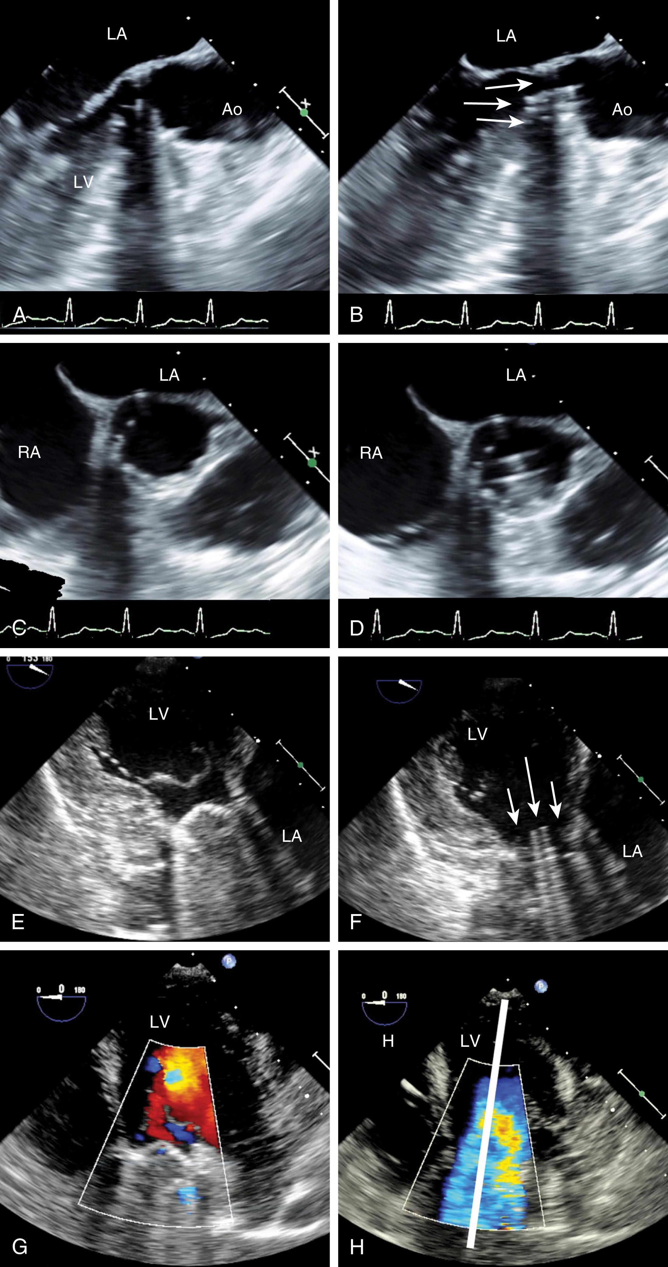 Figure 11.63, Aortic valve replacement: mechanical valve. Normally functioning bileaflet mechanical valve in the aortic position. Left-sided figures were obtained during diastole and right-sided figures during systole. (A–D) Midesophageal long (A and B) and short (C and D) two-dimensional views of the valve. Normal leaflet mobility is noted by seeing the edges of each leaflet during ventricular systole as seen in (B) and (D). (E–H) Transgastric imaging complements transesophageal imaging. Color Doppler imaging shows (G) insignificant insufficiency and (H) normal Doppler flow during systole. Ao , Aorta; LA , left atrium; LV , left ventricle; RA , right atrium.