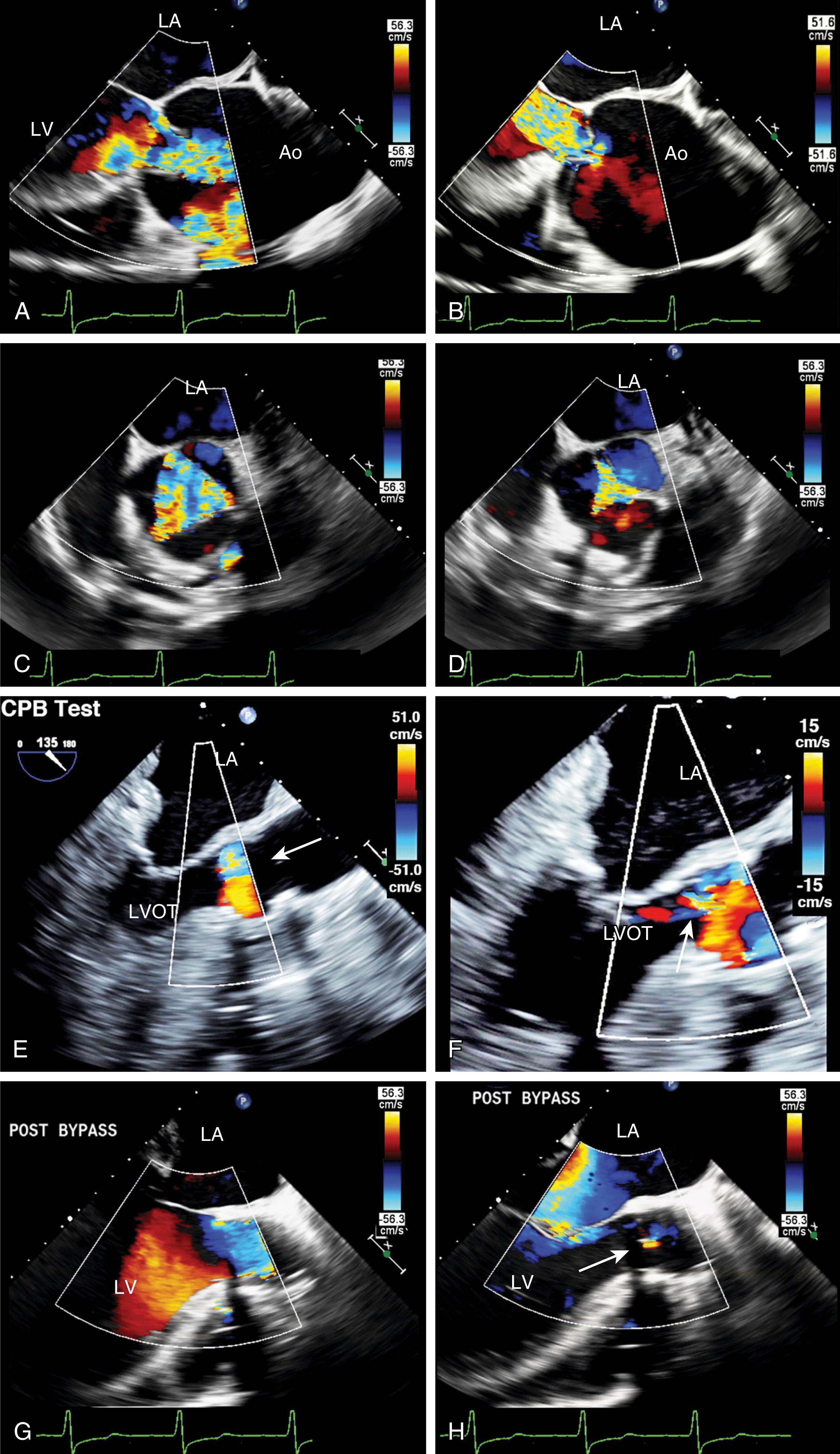 Figure 11.65, Aortic insufficiency (AI) and repair. (A–D) Pre-repair color Doppler images from (A and B) long- and (C and D) short-axis windows depicting severe central AI. Images on the left are obtained during systole and those on the right are obtained during diastole. (E) and (F) were obtained during cardiopulmonary bypass, after repair of the aortic valve. Color Doppler imaging was used and the color scale was adjusted from 51 to 15 cm/s to increase the sensitivity of detecting residual AI. This is accomplished by infusing cardioplegia into the proximal aortic root under 80 mm Hg of pressure measured from the cardiopulmonary bypass (CPB) machine. (G) and (H) were obtained during a stable period after separation from CPB, during (G) systole and (H) diastole and show trace AI. Ao , Aorta; LA , left atrium; LV , left ventricle.