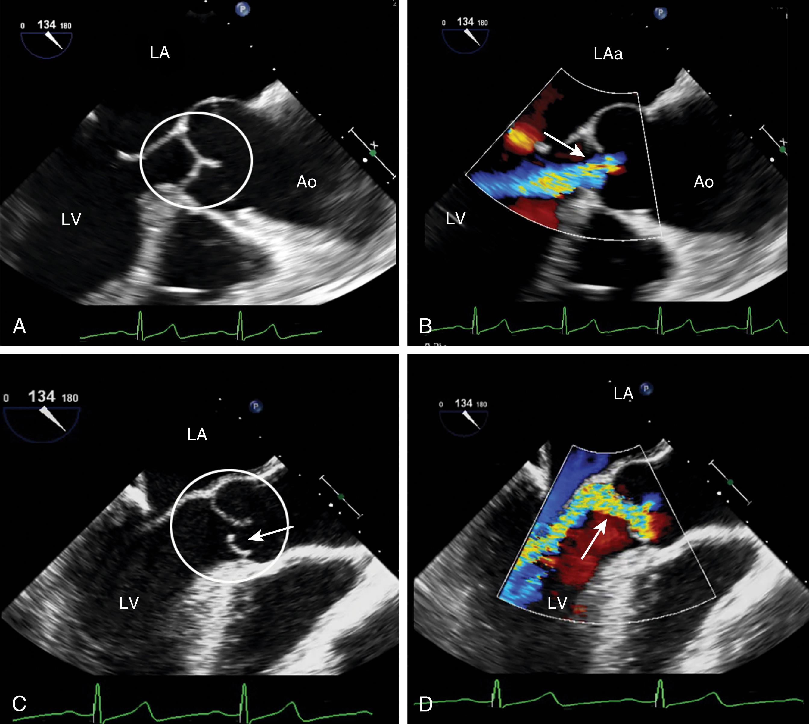 Figure 11.66, Aortic insufficiency (AI) jet direction. The AI jet may be centrally or eccentrically directed. (A) Centrally directed AI, which might be consistent with equally dysfunctional leaflets. (B) Eccentrically directed insufficiency denoting unequal leaflet dysfunction. (C) and (D) The right coronary cusp prolapses ( circle in C) and the AI jet ( arrow in D) is directed away from it. Ao , Aorta; LA , left atrium; LV , left ventricle.