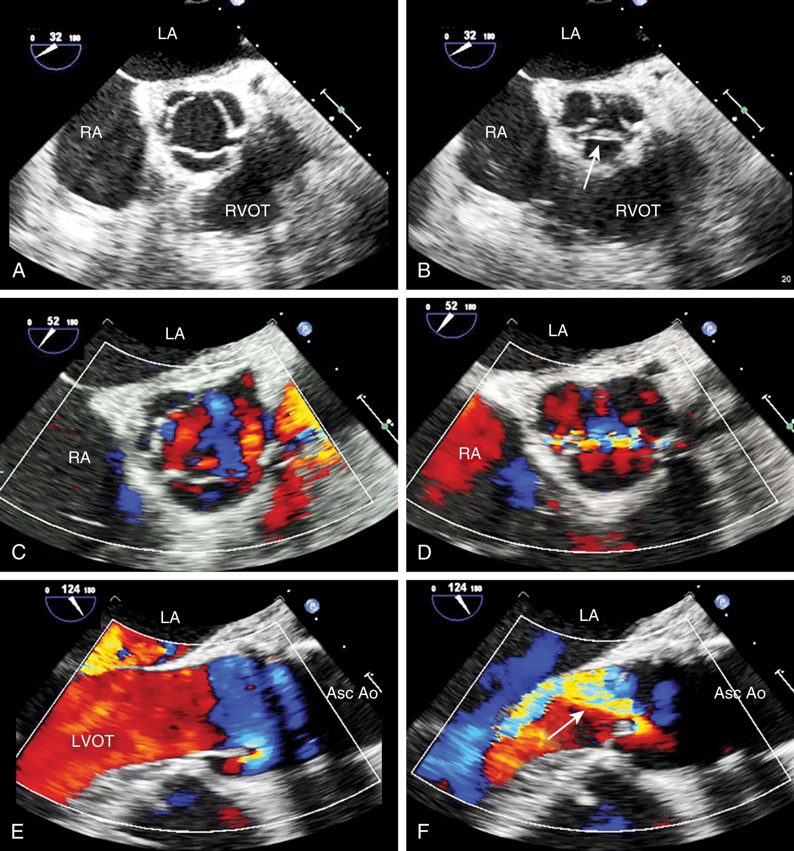 Figure 11.67, Aortic valve (AV) leaflet fenestrations. AV in (A–D) short- and (E and F) long-axis views during systole (left column) and diastole (right column). (B) Right coronary cusp (arrow) appears redundant. In the figure immediately below (D) AV insufficiency is seen at the same level where the valve appears redundant (E). (F) shows an eccentric aortic insufficiency jet which appears to be directed away from the right coronary cusp. Asc Ao , Ascending aorta; LA , left atrium; LVOT , left ventricular outflow tract; RA , right atrium; RVOT , right ventricular outflow tract.