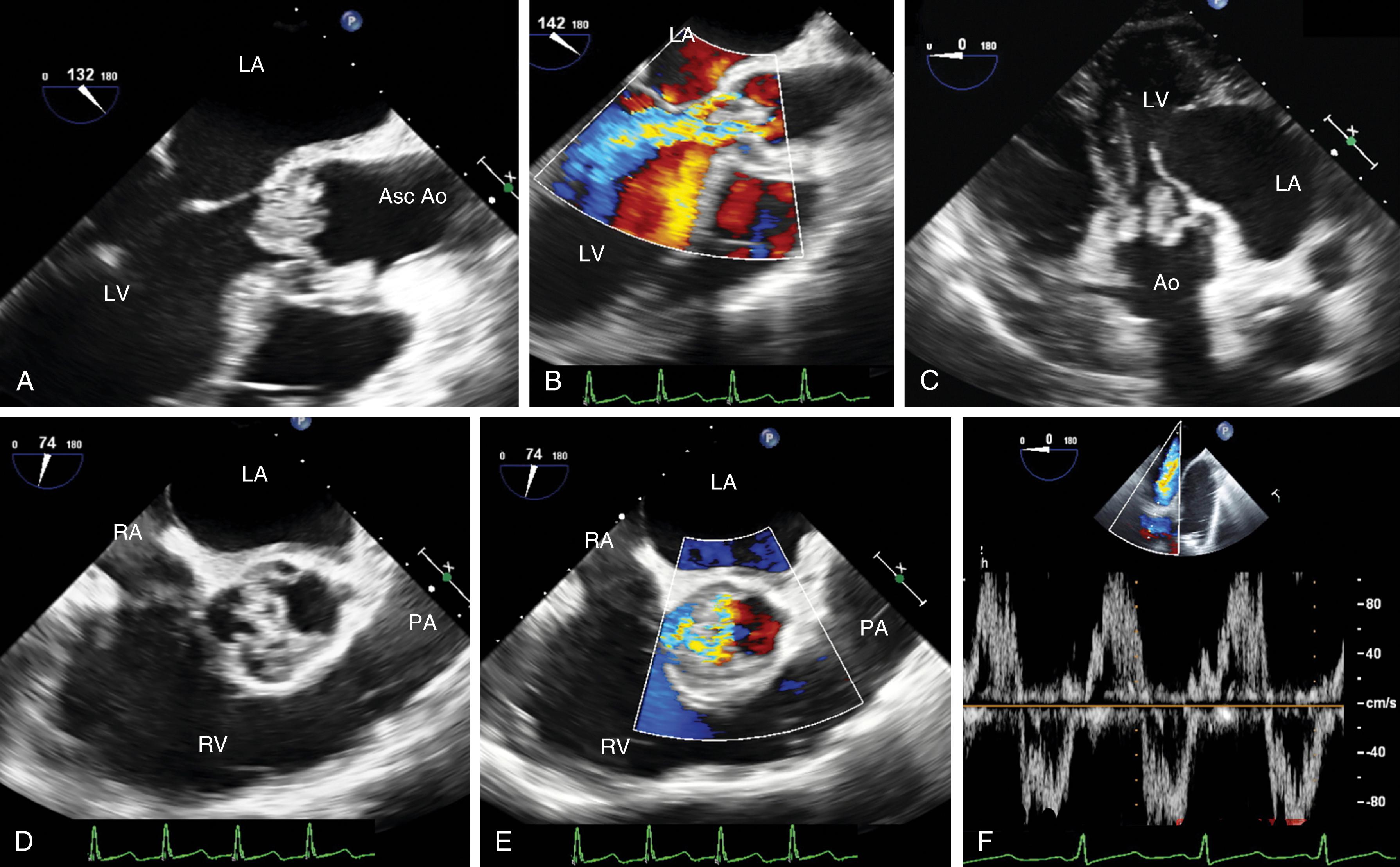 Figure 11.68, Aortic insufficiency caused by endocarditis. Endocarditis of the aortic valve (AV) can manifest with a range of leaflet/annular/aortic disease and insufficiency. (A) and (B) Significant leaflet involvement and severe insufficiency. (C) Transgastric imaging showing significant involvement of the AV. (A–C) show thickened, irregular, and flail AV leaflets, which are associated with large mobile masses. (D) and (E) AV in short-axis view with and without color Doppler, showing severe insufficiency. (F) Pulsed-wave Doppler of the ascending aorta showing diastolic flow reversal consistent with severe dysfunction. Asc Ao , Ascending aorta; LA , left atrium; LV , left ventricle; PA , pulmonary artery; RA , right atrium; RV , right ventricle.