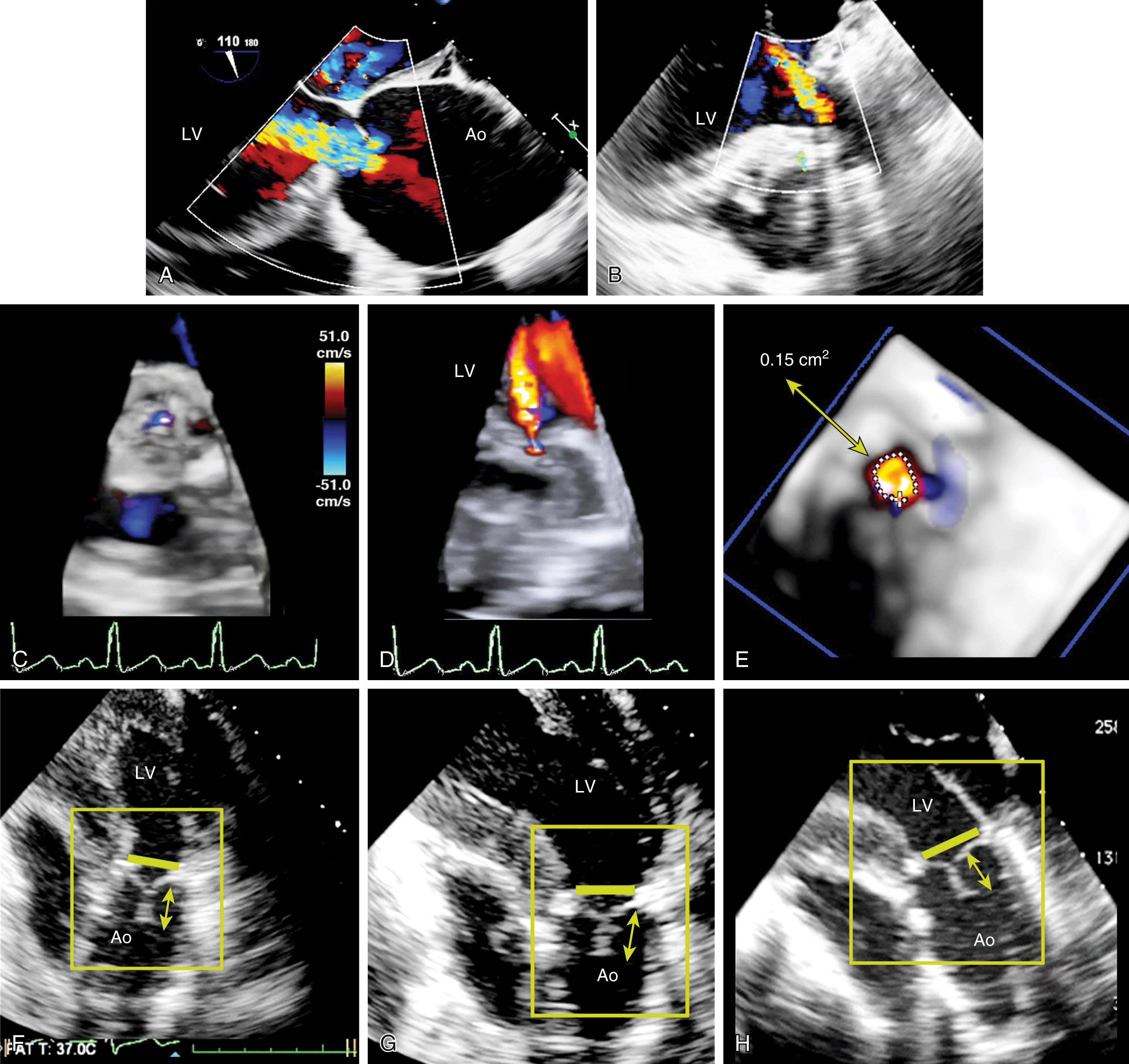 Figure 11.71, Aortic insufficiency (AI) and repair. These images demonstrate the benefits of performing a comprehensive echocardiographic exam using different ultrasound modalities and both transesophageal and gastric windows. (A) Pre-repair and (B) postrepair midesophageal long-axis color Doppler views show significant AI. Post-repair image shows a significant color Doppler profile but the valve is not well seen. (C) Midesophageal and (D) and (E) transgastric windows, three-dimensional volumetric color data sets allow visualizations of the regurgitant jet below, at, and above the valve. (D) Narrow jet of insufficiency at the valvular level, which expands due to entrainment. Editing the data set allows planimetry of the regurgitant jet, which measures 0.15 cm 2 in area consistent with mild AI. (F–H) Transgastric two-dimensional images allowing visualization of the coaptation level (ie, no residual prolapse; solid line ) and coaptation length (arrow line). Ao , Aorta; LV , left ventricle.