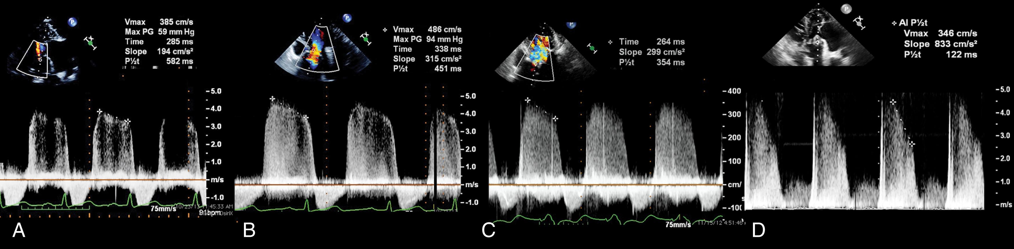 Figure 11.72, Pressure half-time (PHT): aortic insufficiency (AI). (A–D) From left to right the Doppler profiles show reduction in PHTs from 582 ms to 122 ms, which is consistent with increasing severity of AI. The limitation of the PHT assessment is the impact on net compliance, which in turn is affected by a host of variables including acuity of AI, coexistence of aortic valve stenosis, and a history of hypertension. Although supportive of different degrees of AI, the PHT assessment should not be used as the sole determinant of AI severity. Qualitatively, the Doppler profile in (A) is not as dense or complete as the others, reflecting the regurgitant volume. The more cells that pass through, the more dense the flow profile will be.