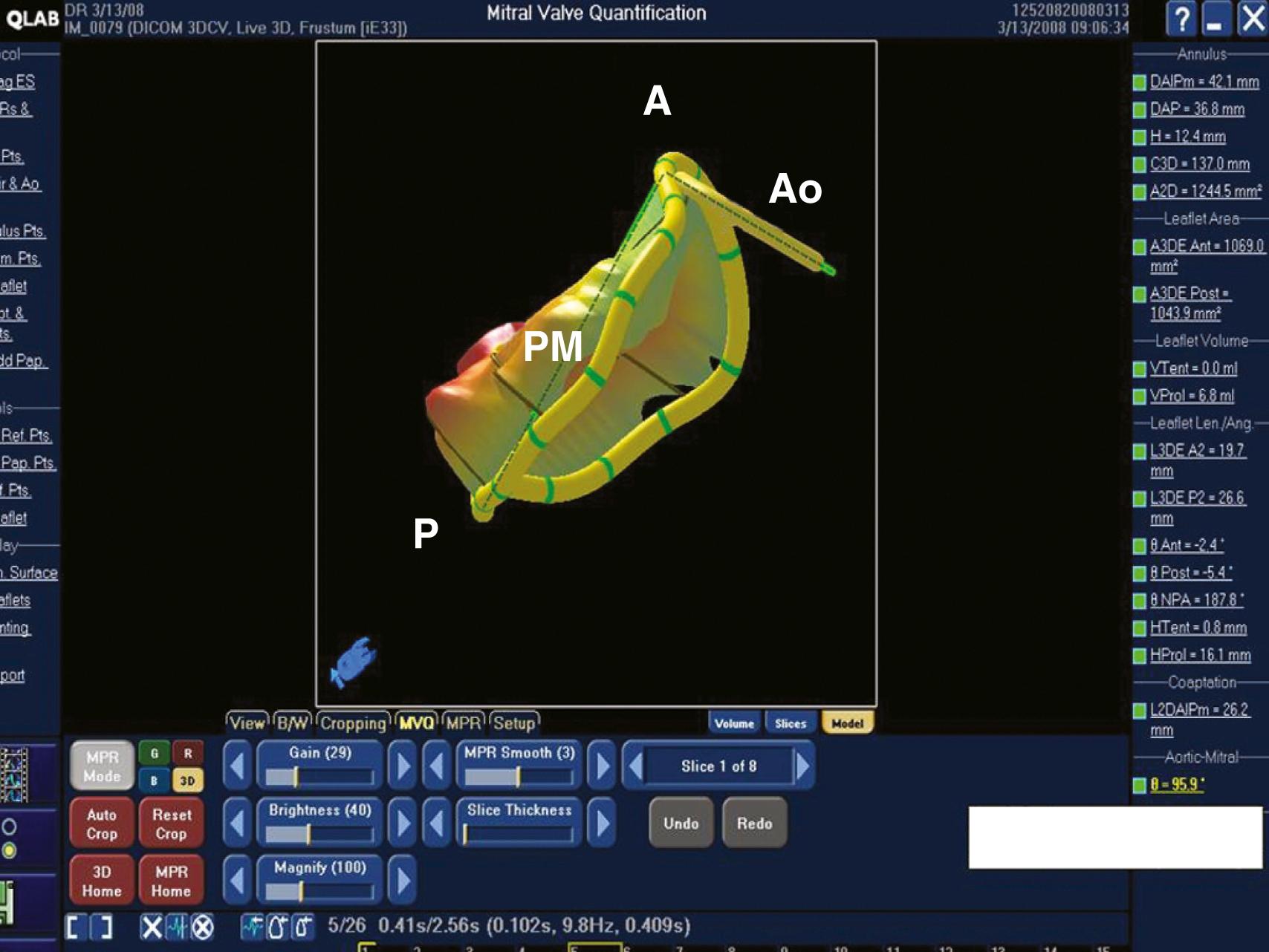 Figure 11.8, Mitral valve quantification showing the aortomitral angle of 95.9 degrees. Patient at increased risk for development of systolic anterior motion after mitral valve repair surgery. A , Anterior; Ao , aorta; P , posterior; PM , posteromedial.