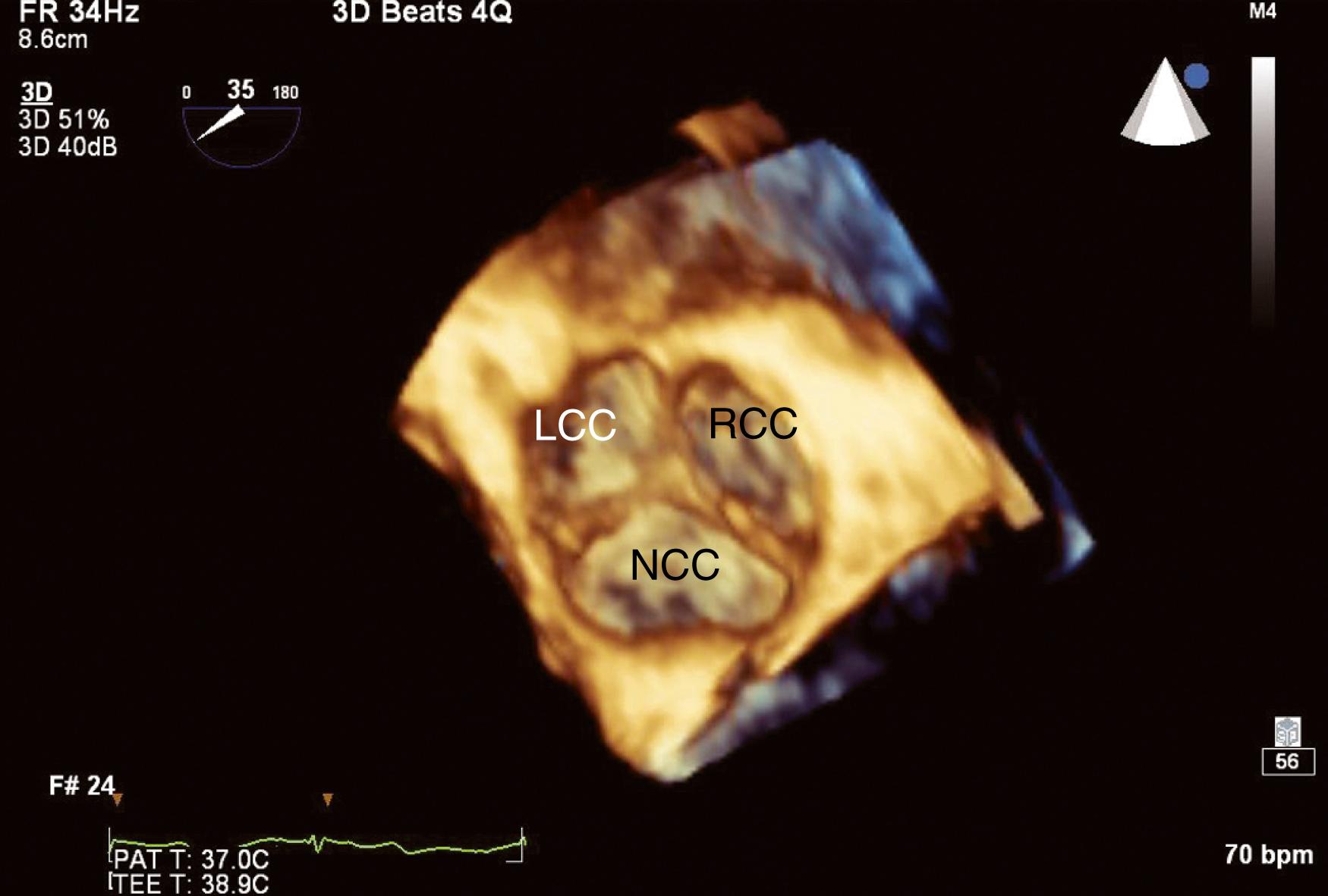 Figure 11.9, Three-dimensional transesophageal echocardiographic image of the aortic valve displayed in the surgeon’s view. LCC , Left coronary cusp; NCC , noncoronary cusp; RCC , right coronary cusp.