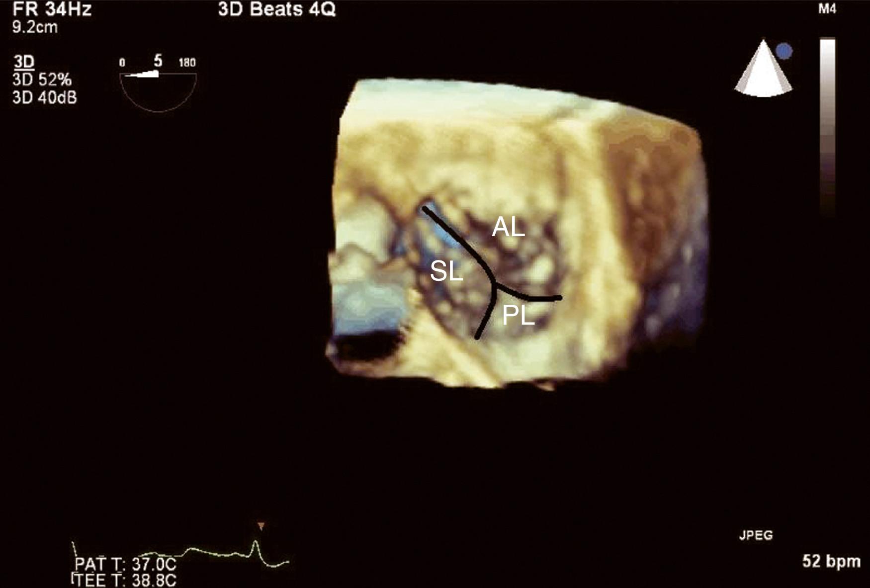 Figure 11.10, Three-dimensional transesophageal echocardiographic image of the tricuspid valve displayed in the surgeon’s view. AL , Anterior leaflet; PL , posterior leaflet; SL , septal leaflet.