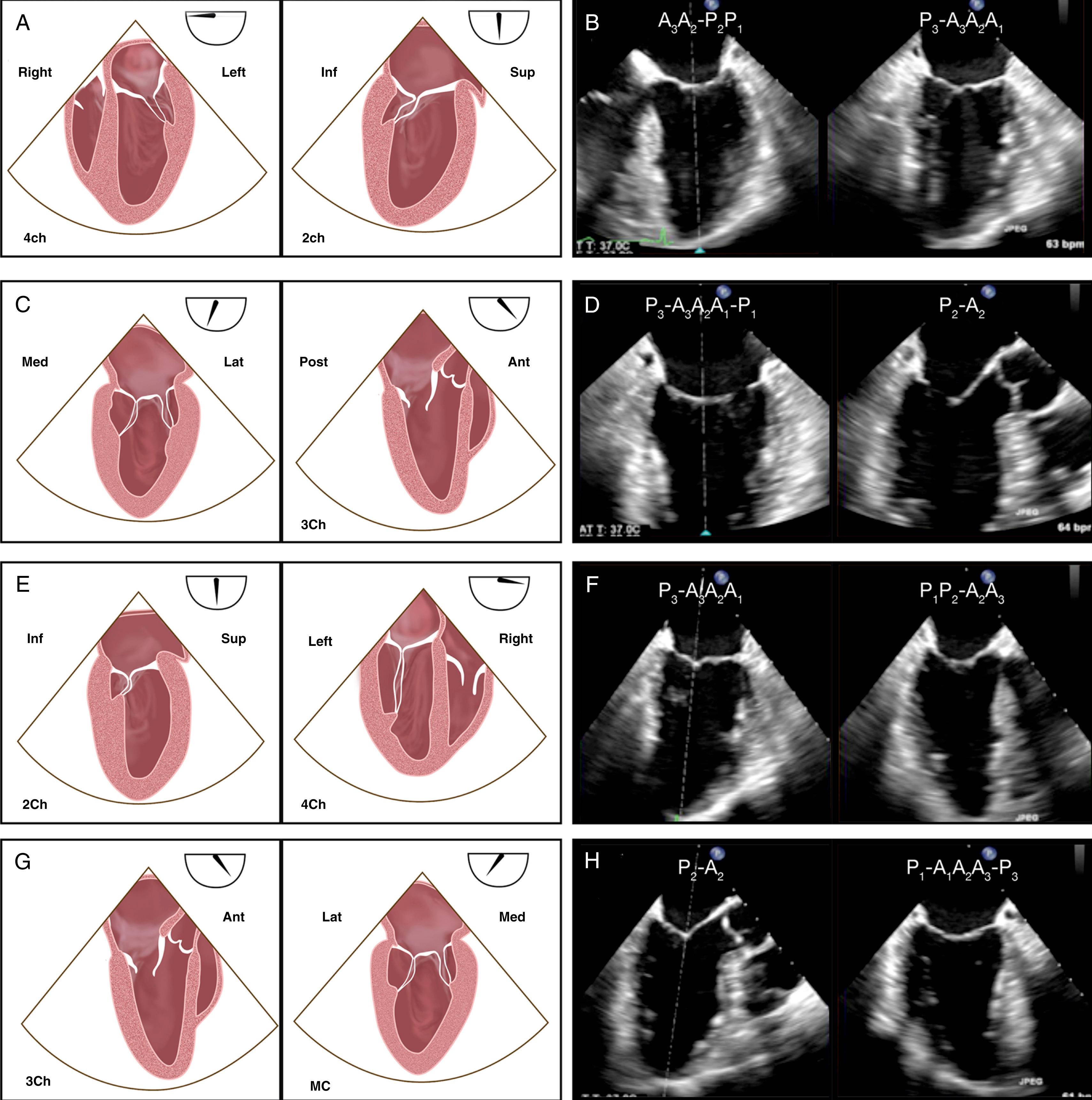 Figure 13.6, Simultaneous multiplane transesophageal echocardiographic image display. Simultaneous multiplane imaging permits the use of a dual screen to simultaneously display two real-time 2D images. In these examples, the primary image (on the left in each panel) is the reference view, with the second view (on the right in each panel) orthogonally rotated 90° to the primary view, but any tilt angle can be used for the secondary view. The typical 90° orthogonal second image is oriented as if the rotation has occurred in a clockwise manner and, for some views, appears ‘‘left-right reversed’’ compared with single-plane imaging. A, B, The primary view is the mid-esophageal (ME) four-chamber (4Ch) view. C, D, The primary view is the ME mitral commissural (MC) view. E, F, The primary view is the ME two-chamber (2Ch) view. G, H, The primary view is the ME LAX view. A, anterior; Ant, anterior; Inf, inferior; Lat, lateral; MC, mitral commissural; Med, medial; P, posterior; Sup, superior.