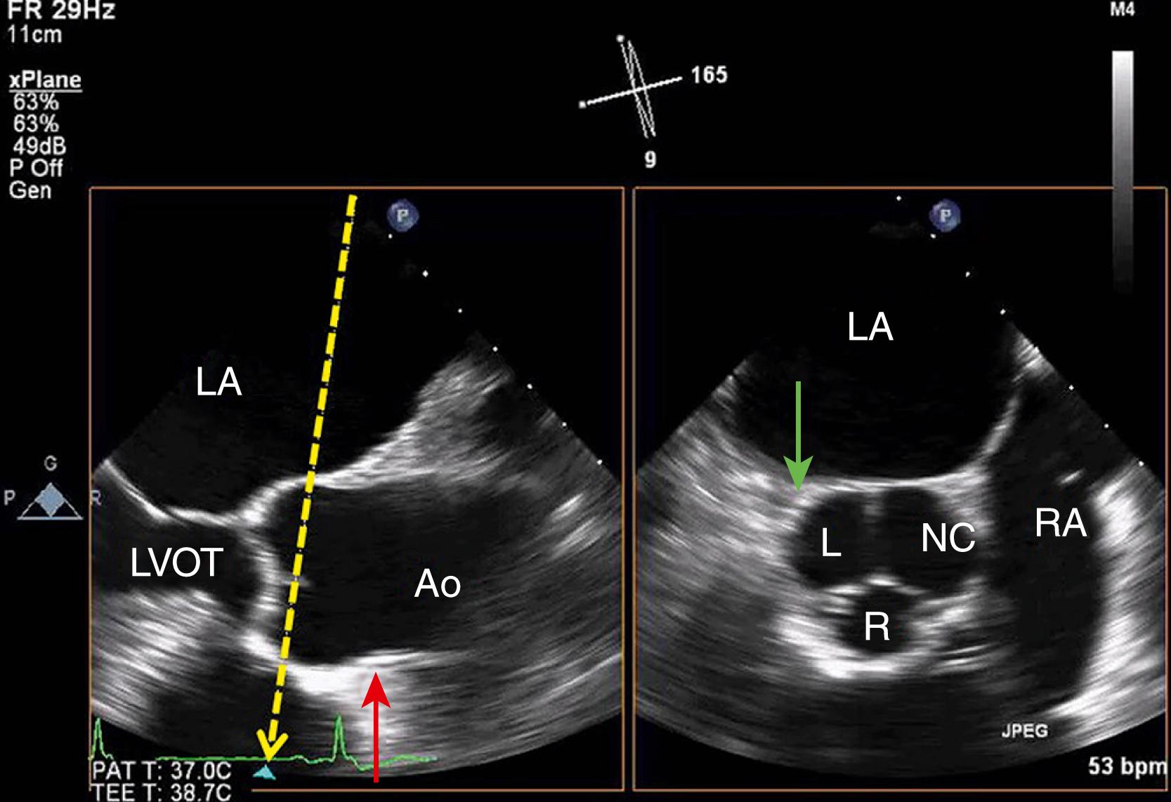 Figure 13.7, Simultaneous multiplane imaging of the aortic valve. From the midesophageal long-axis view of the aorta (view #6), the simultaneous orthogonal view is the short-axis view of the aorta. However, this view appears inverted from the single-plane midesophageal short-axis view (view #10). From these views, the right coronary artery (red arrow) and left coronary artery (green arrow) can be imaged. See text for abbreviations.